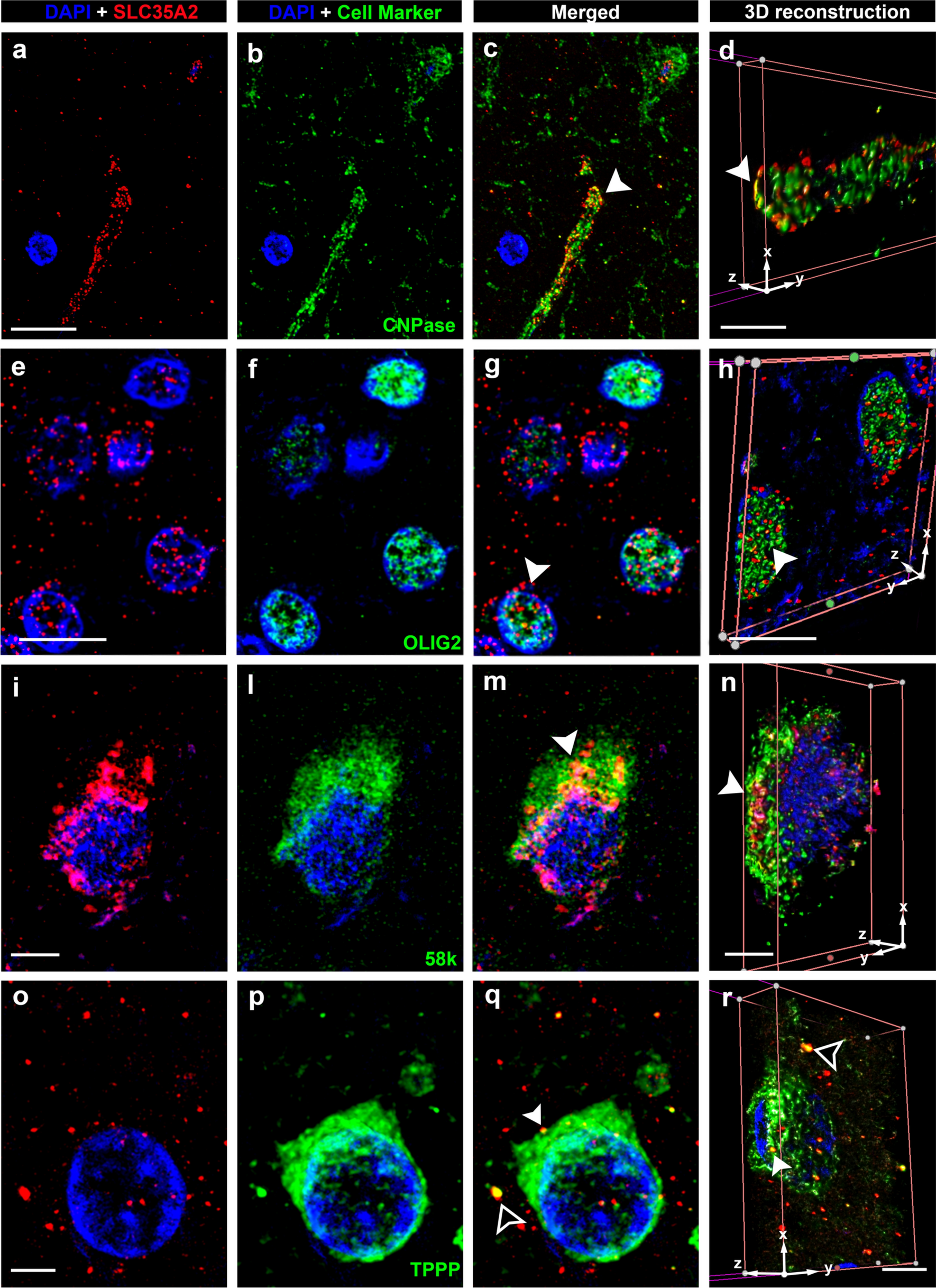 Human brain tissue with MOGHE carrying somatic  variants reveal aberrant protein expression and protein loss in the white matter