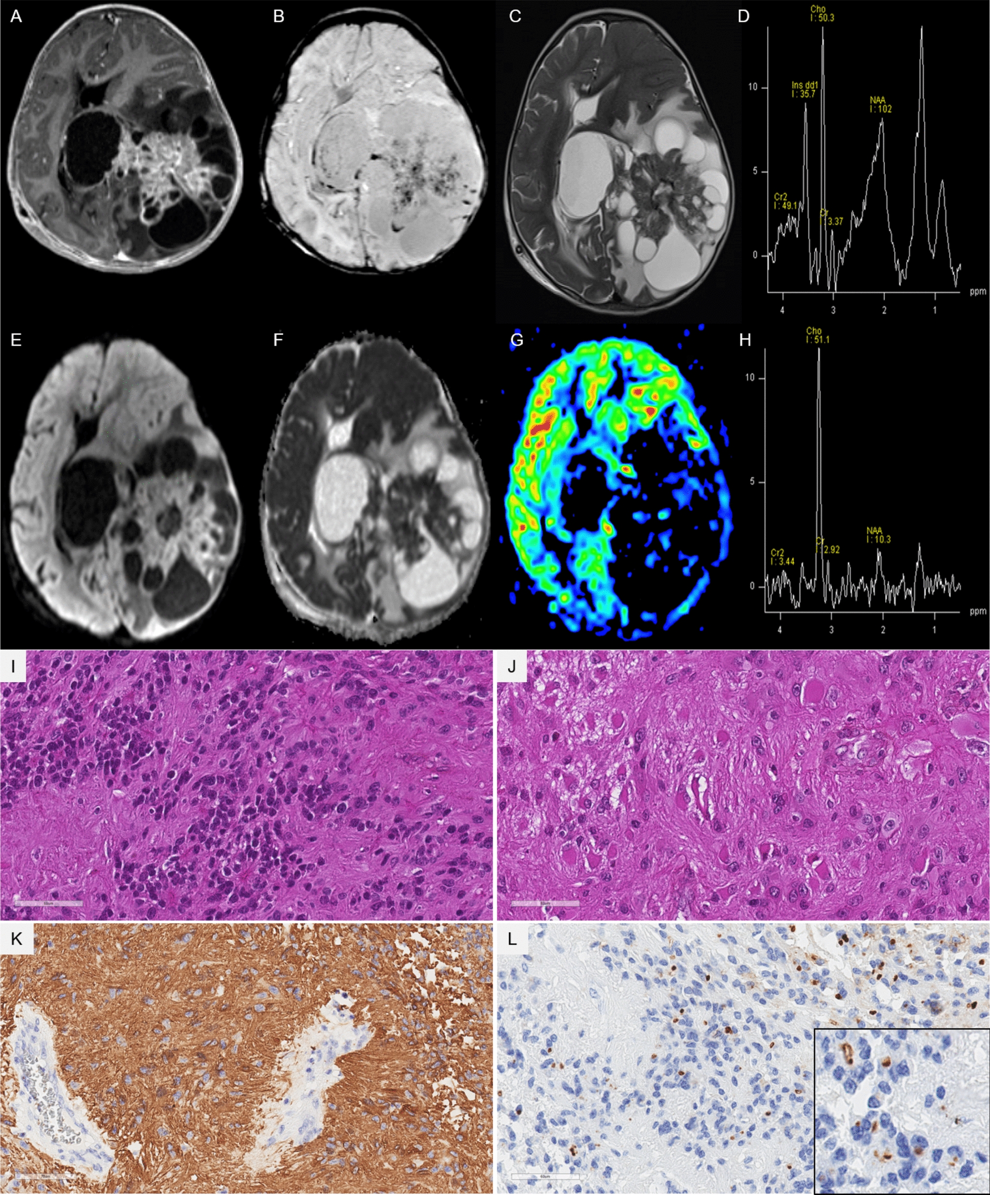 A novel  fusion that potentially expands the concept of supratentorial ependymoma,  fusion-positive