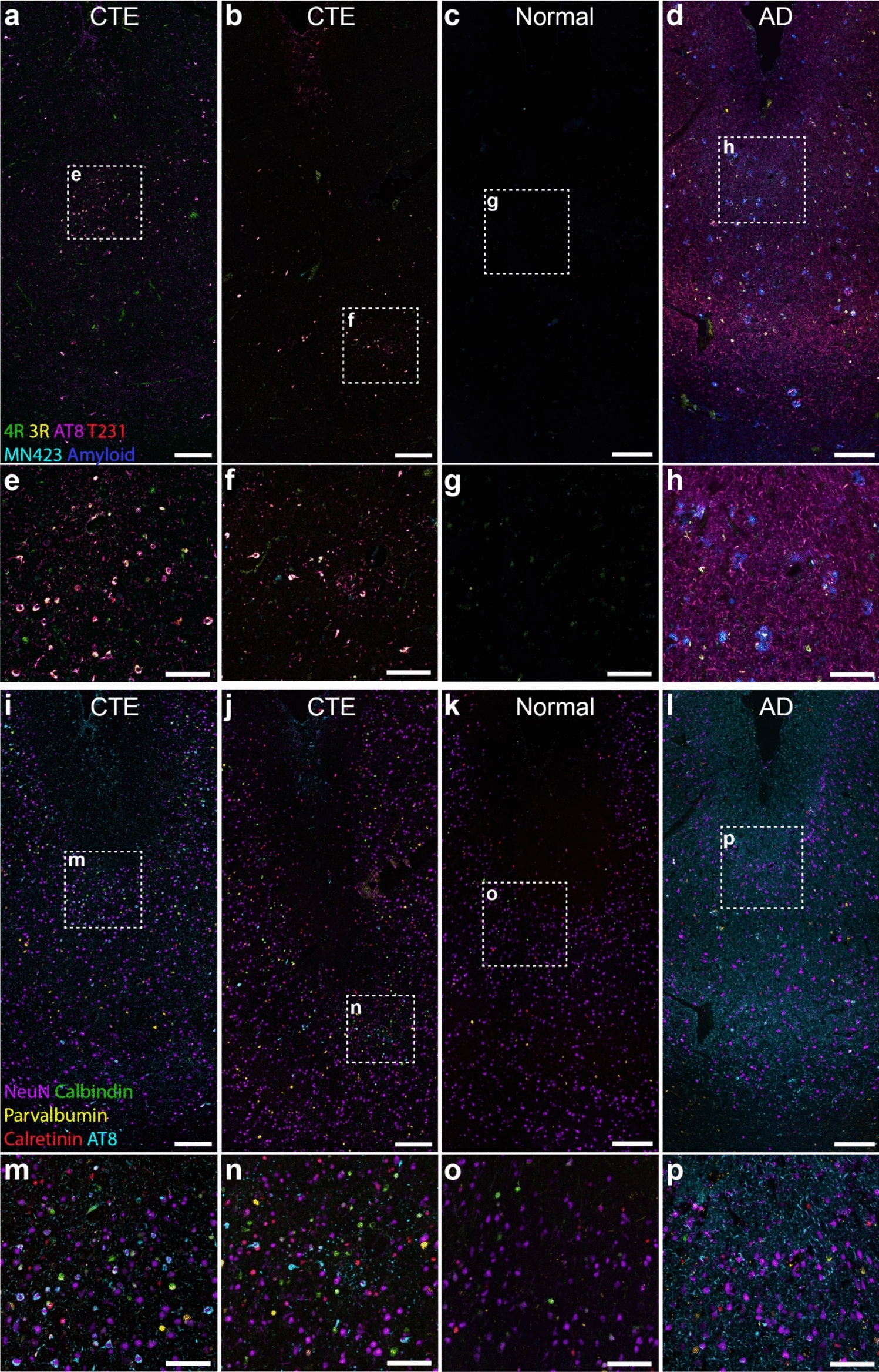 Perivascular glial reactivity is a feature of phosphorylated tau lesions in chronic traumatic encephalopathy