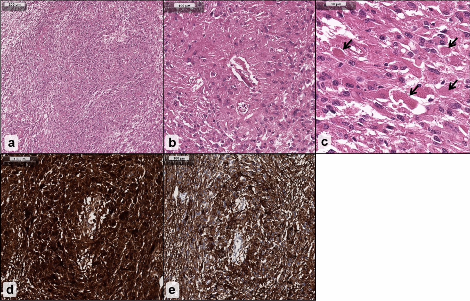 fusion driver in primary central nervous system malignancy: case report
