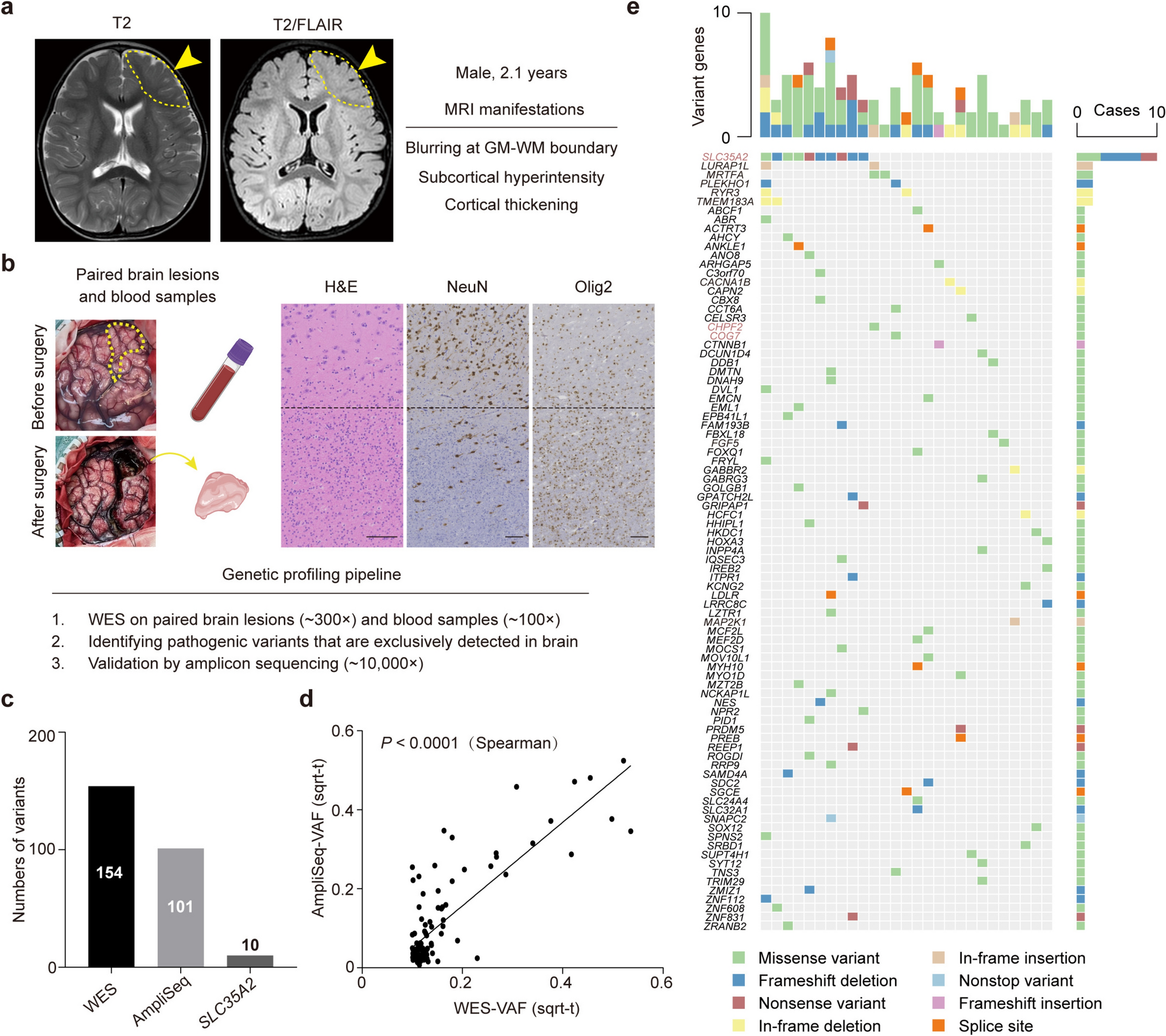 Somatic variants in  leading to defects in N-glycosylation in mild malformation of cortical development with oligodendroglial hyperplasia in epilepsy (MOGHE)