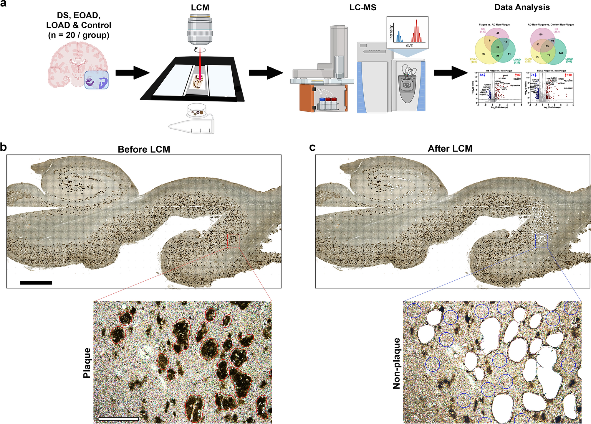 Comparison of the amyloid plaque proteome in Down syndrome, early-onset Alzheimer’s disease, and late-onset Alzheimer’s disease