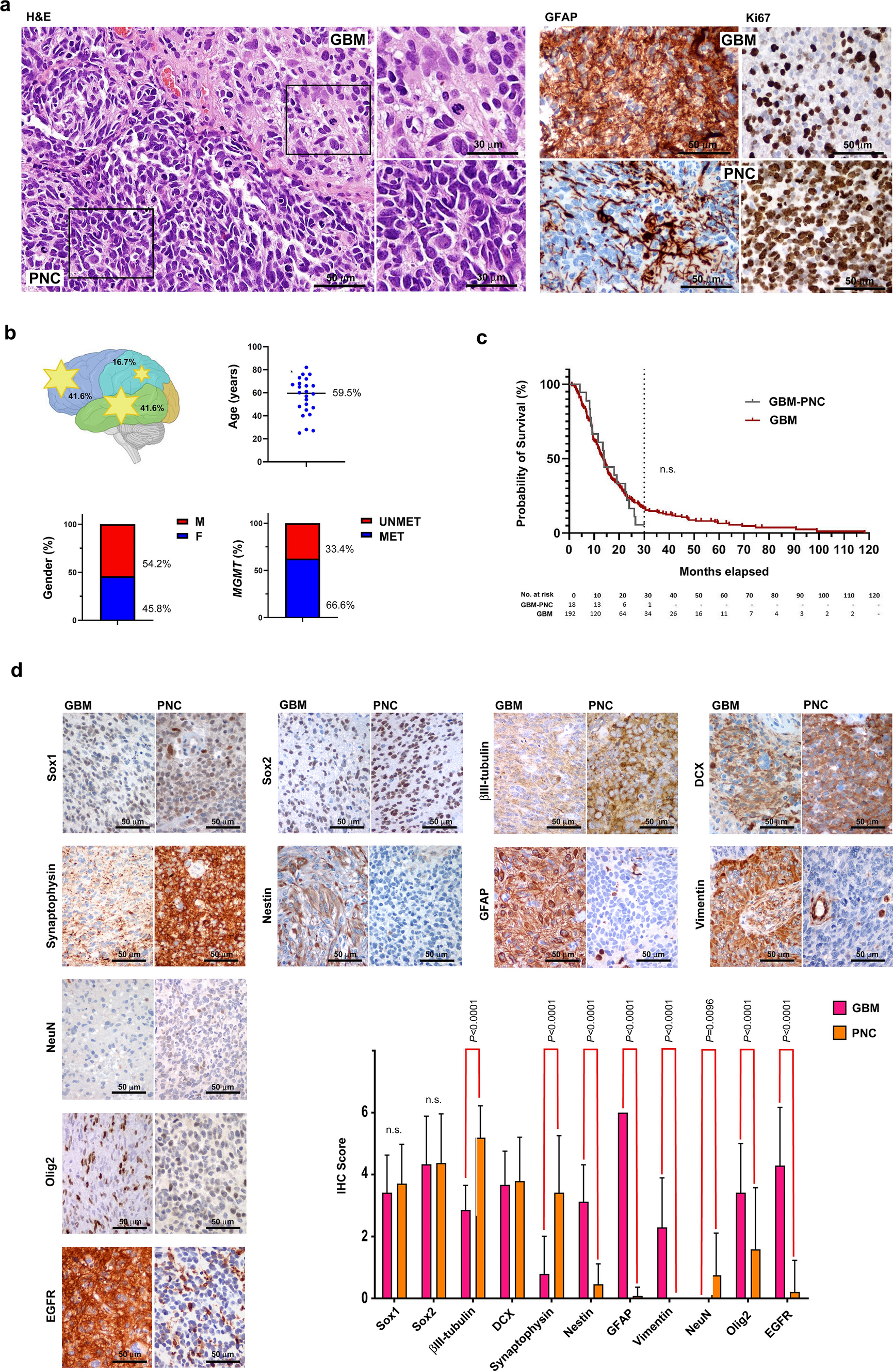 Concurrent RB1 and P53 pathway disruption predisposes to the development of a primitive neuronal component in high-grade gliomas depending on MYC-driven EBF3 transcription