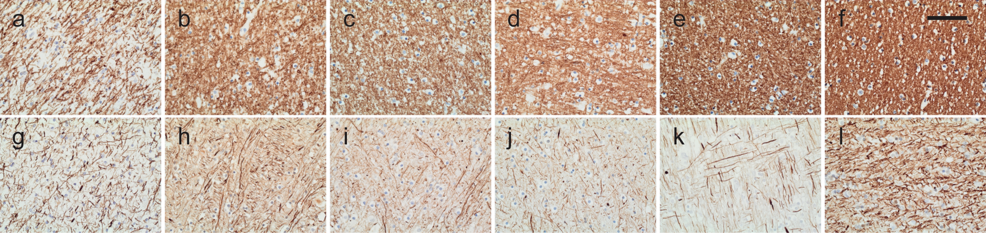 White matter pathology in FTLD caused by  mutations