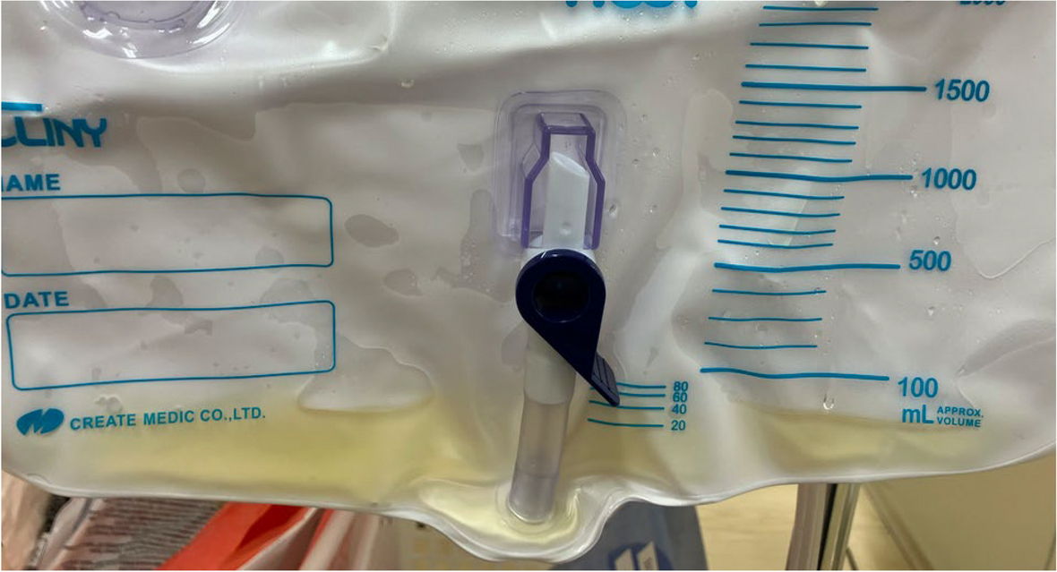 Delay in detection of urethral catheter misplacement in the vagina of an older adult patient due to urinary outflow during catheterization: a case report