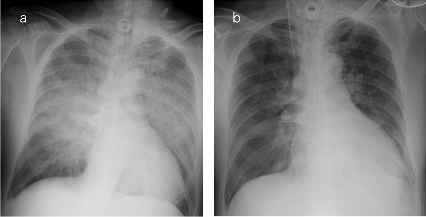Unexpected negative-pressure pulmonary edema after tracheostomy: two case reports