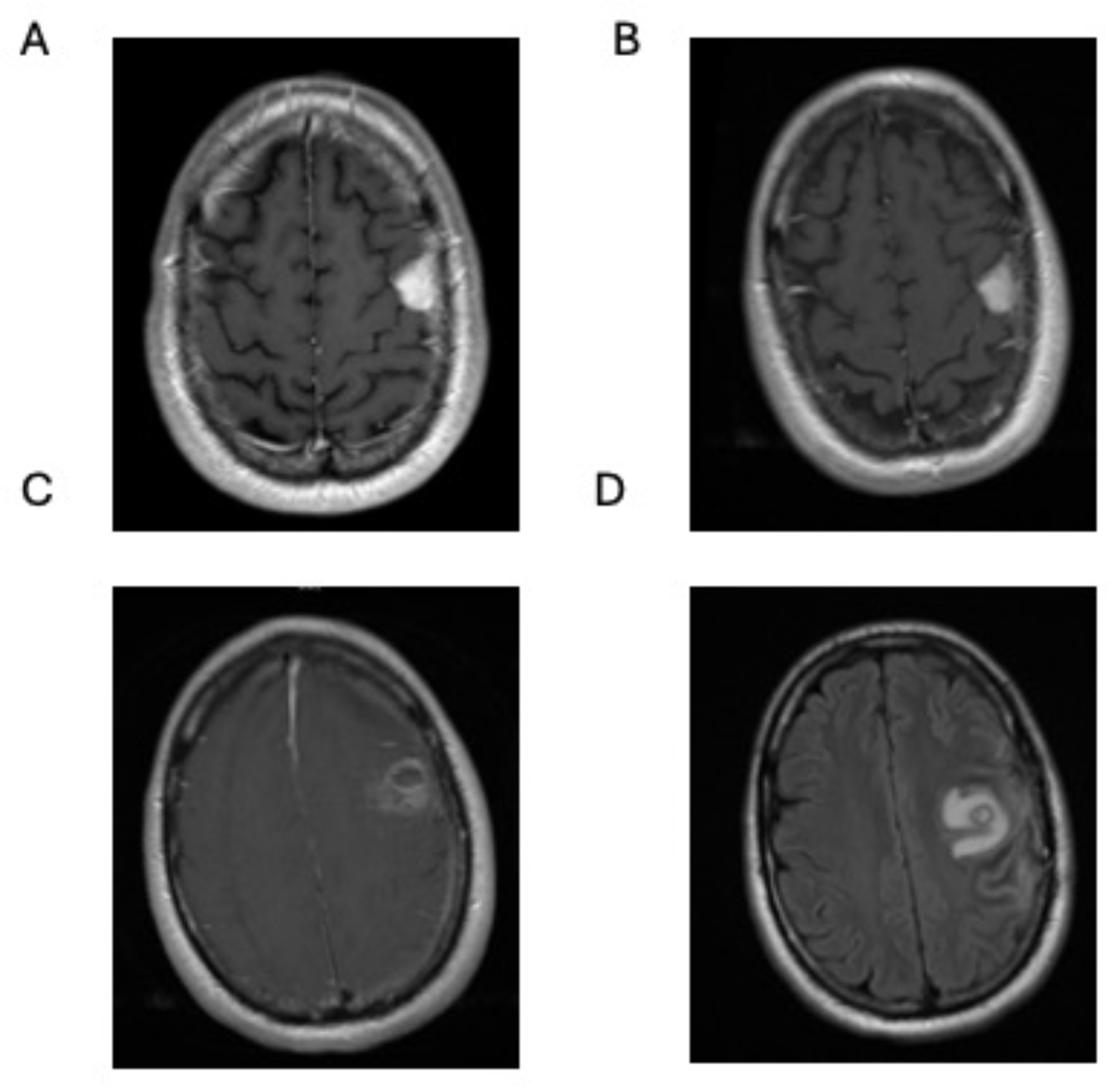 Collision tumor, a metastatic melanoma within a meningioma: a case report