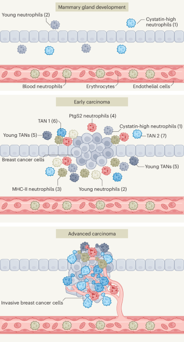 Neutrophils take their PICk to promote breast cancer