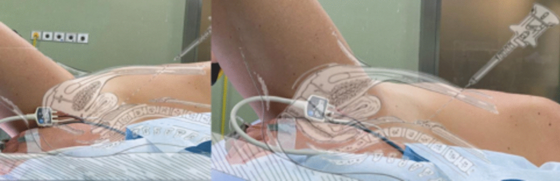 Prevention and Treatment of Intraoperative Complications During Gynecological Laparoscopic Surgery: Practical Tips and Tricks—A Narrative Review