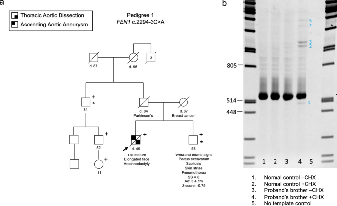 Non-canonical splice variants in thoracic aortic dissection cases and Marfan syndrome with negative genetic testing