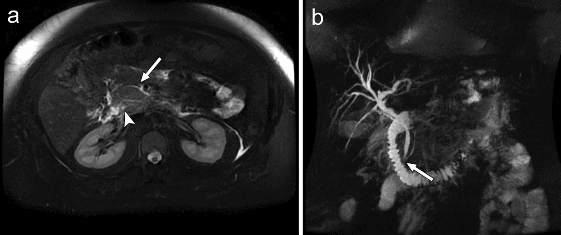 Pancreatitis-related benign biliary strictures: a review of imaging findings and evolving endoscopic management