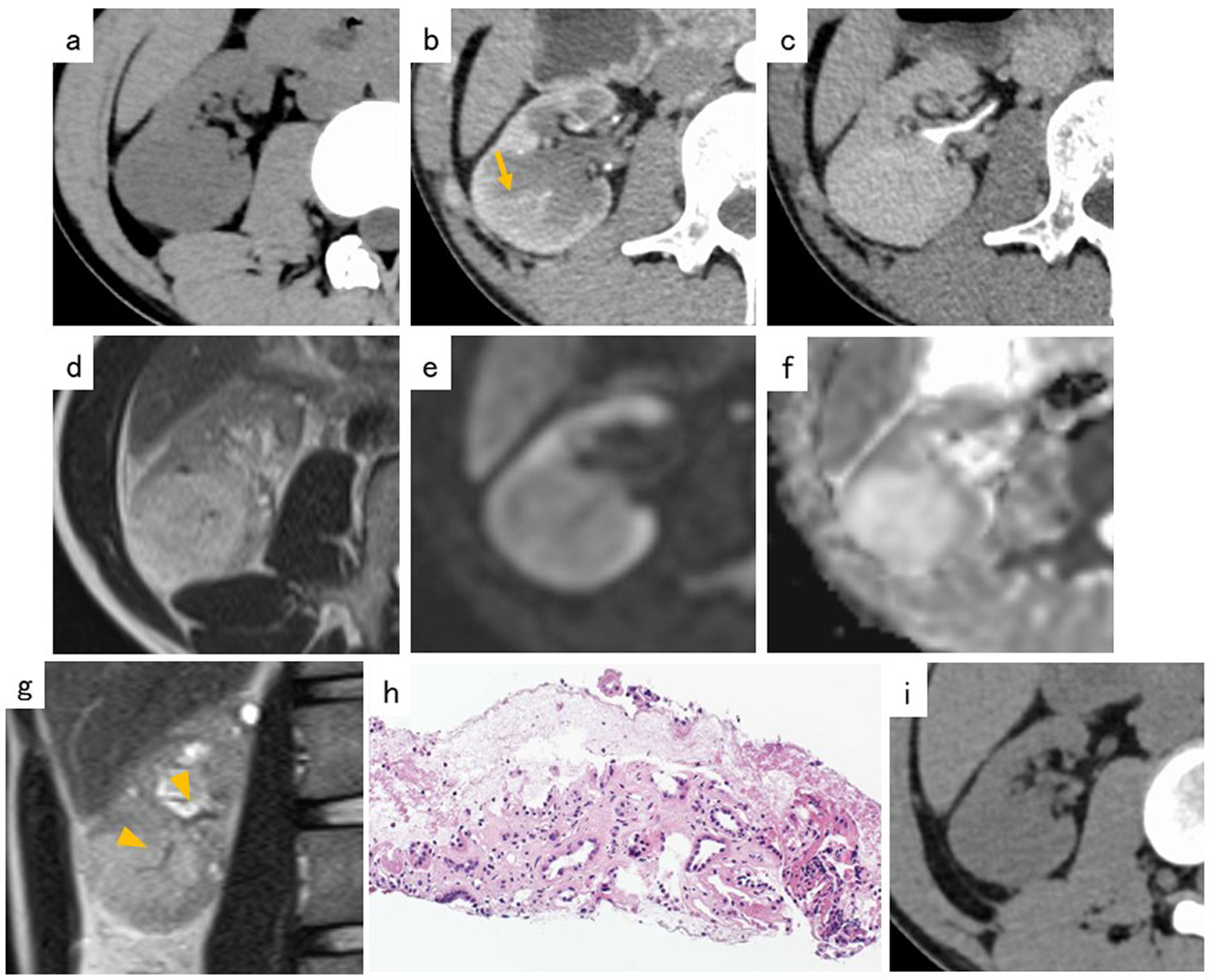 Renal pseudotumours in End-Stage renal disease: CT and MRI findings in two rare cases