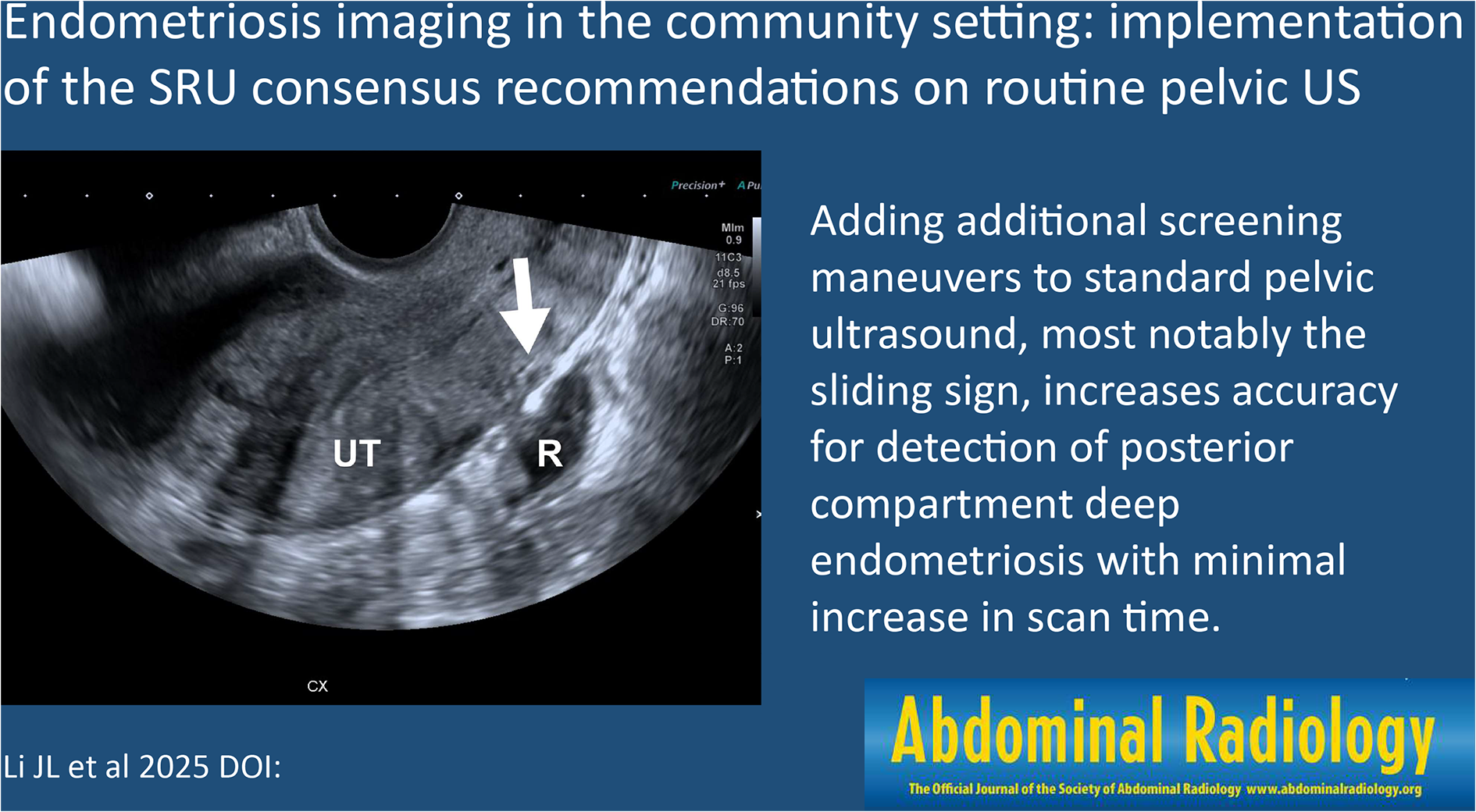Endometriosis imaging in the community setting: implementation of the SRU consensus recommendations on routine pelvic US