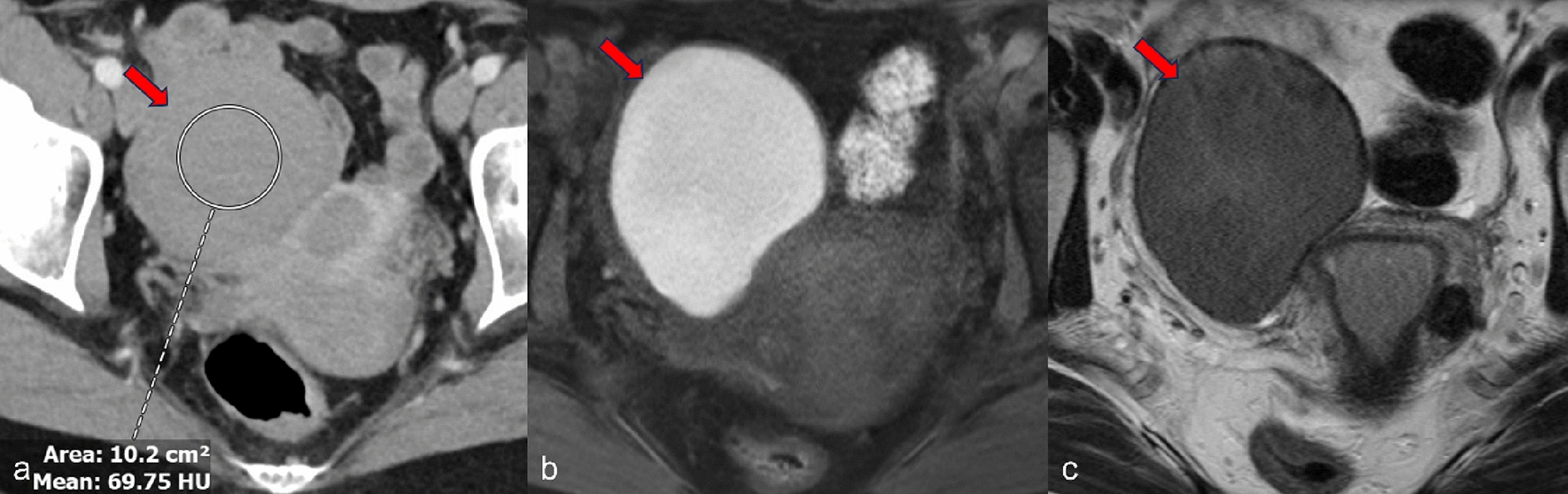 Role of computed tomography in imaging of endometriosis