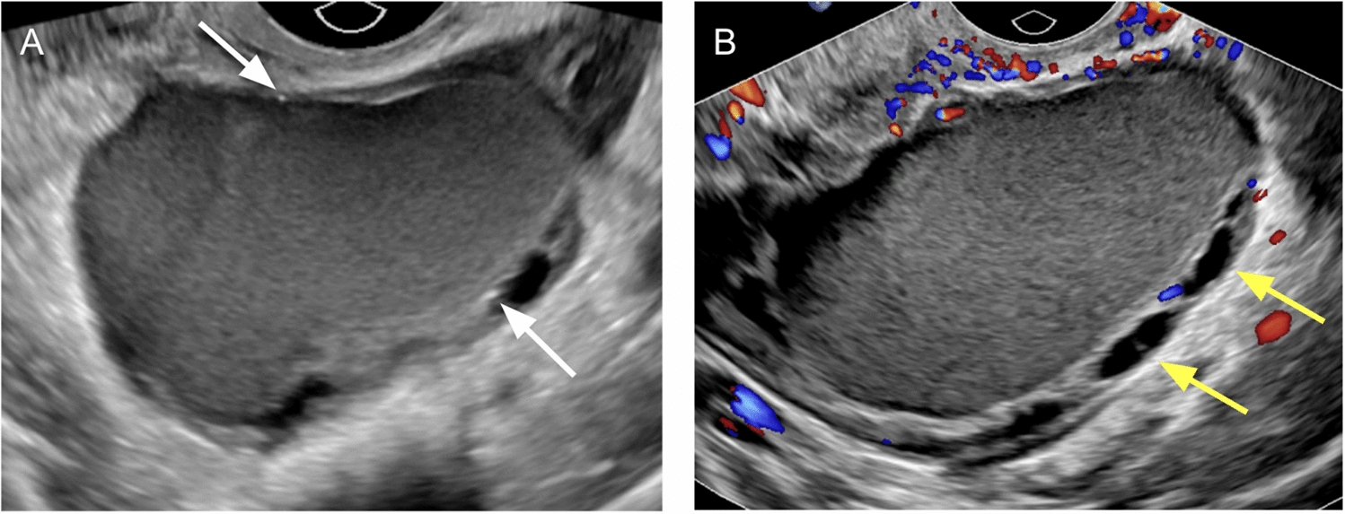Endometriosis: assessment on O-RADS and risk of malignant transformation