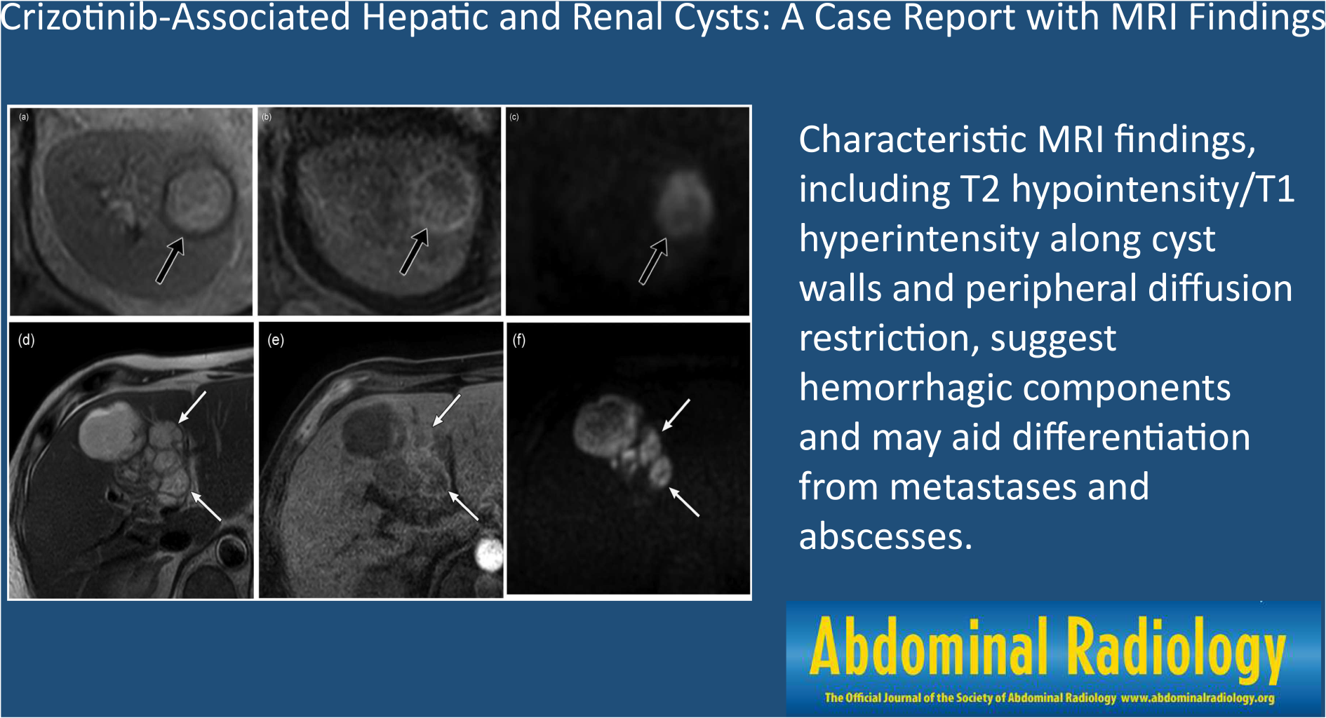 Crizotinib-associated hepatic and renal cysts: a case report with MRI findings
