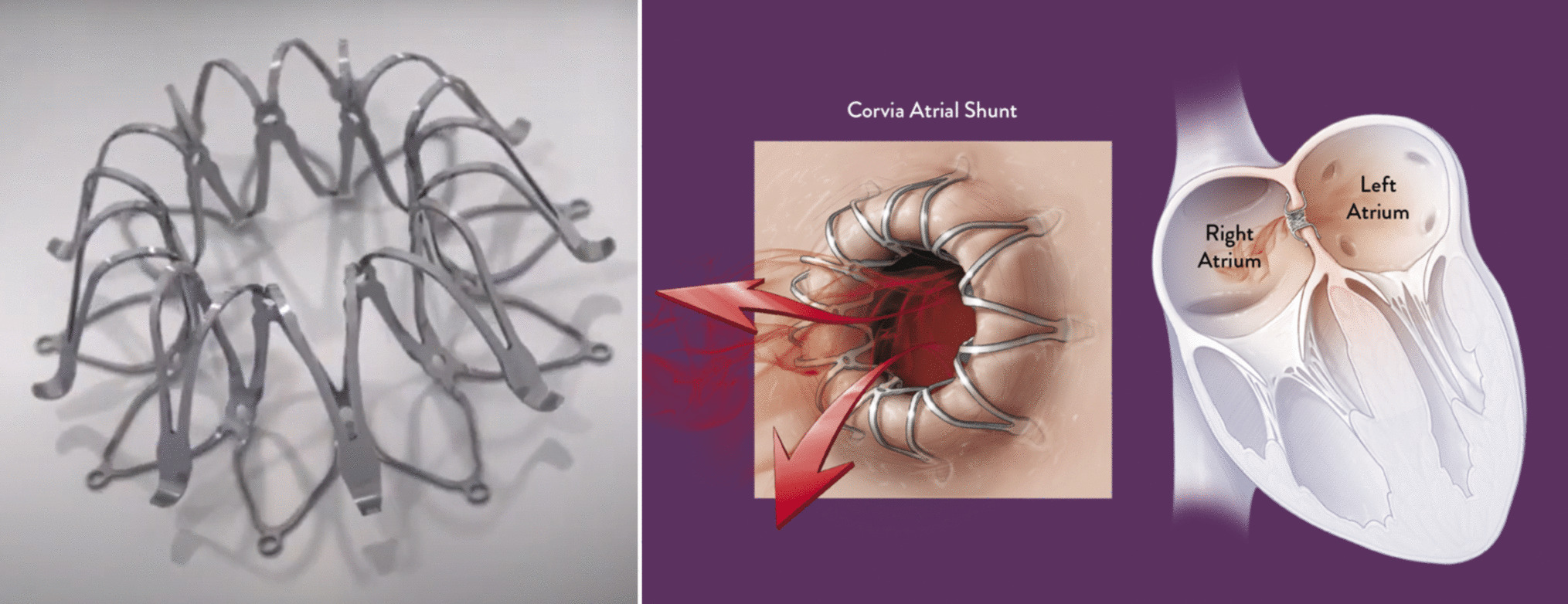 Left atrial shunting devices: why, what, how, and… when?