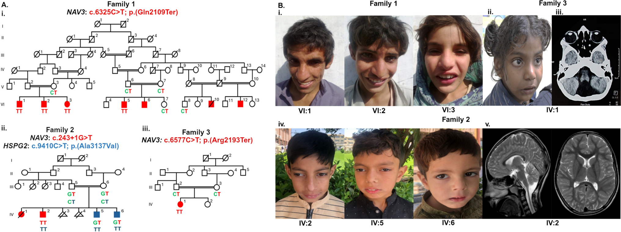 Further evidence of biallelic  variants associated with recessive neurodevelopmental disorder with dysmorphism, developmental delay, intellectual disability, and behavioral abnormalities