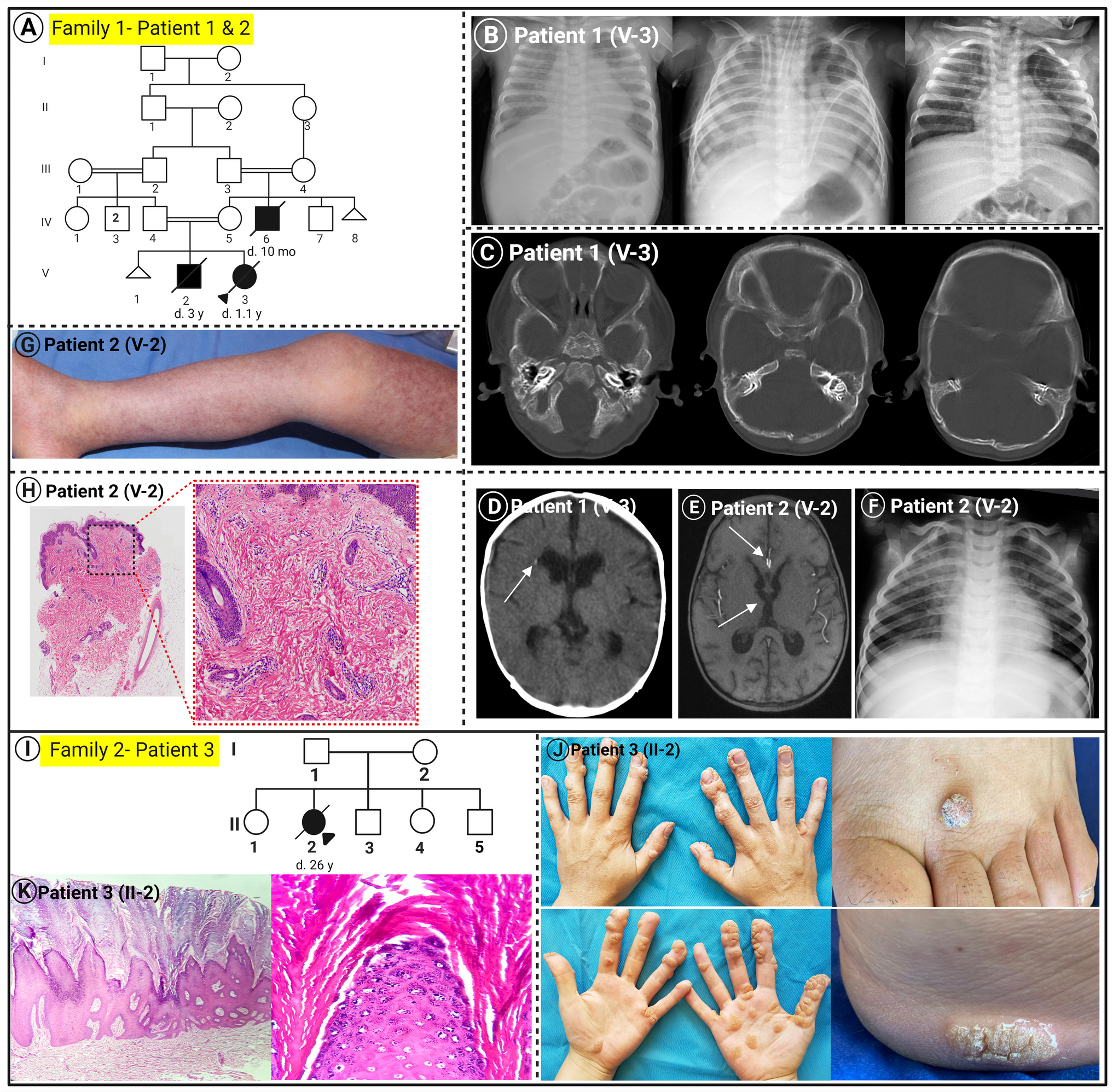 DOCK2 Deficiency and GATA2 Haploinsufficiency Can Underlie Critical Coronavirus Disease 2019 (COVID-19) Pneumonia