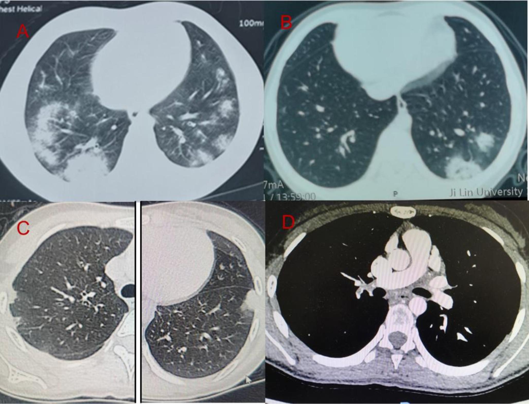 Clinical Characteristics and Outcomes of Pediatric Cases Presenting with Possible Pulmonary Vasculitis Following COVID-19 Infection