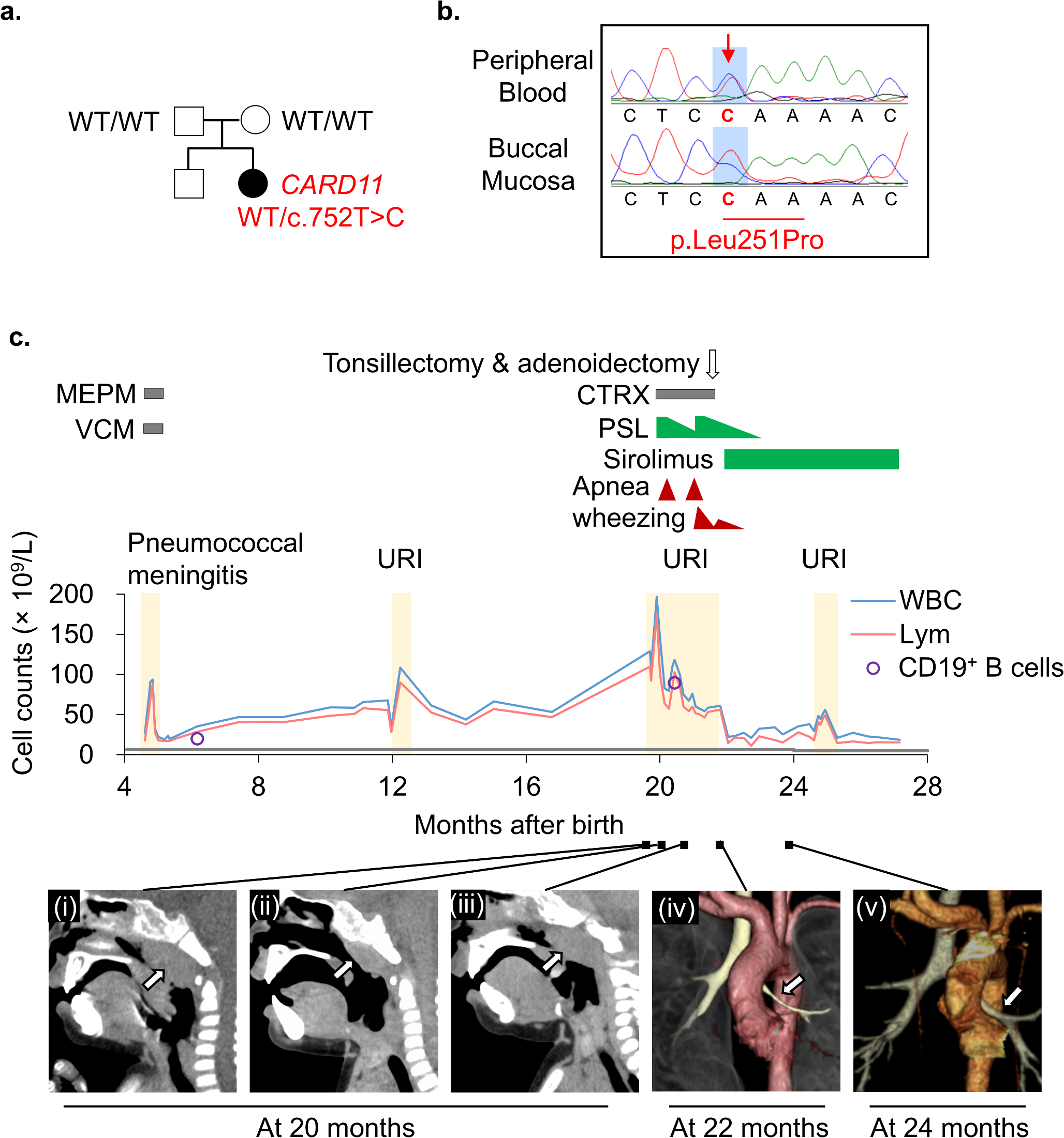 Successful Treatment with Sirolimus of a Patient with a Novel  Germline Mutation in B-Cell Expansion with Nuclear Factor Kappa B and T-Cell Anergy: Case Report and Literature Review