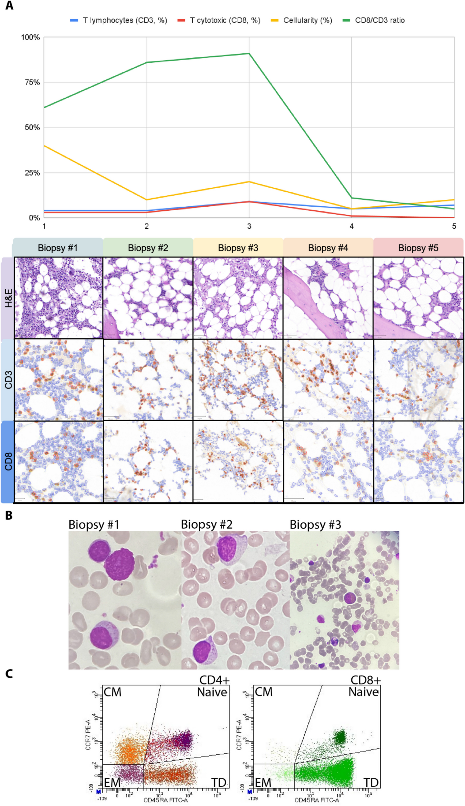 Bone Marrow CD8 + Abundance Inversely Correlates with Progressive Marrow Fibrosis and Myelodysplastic Evolution in GATA2 Deficiency: Case Report