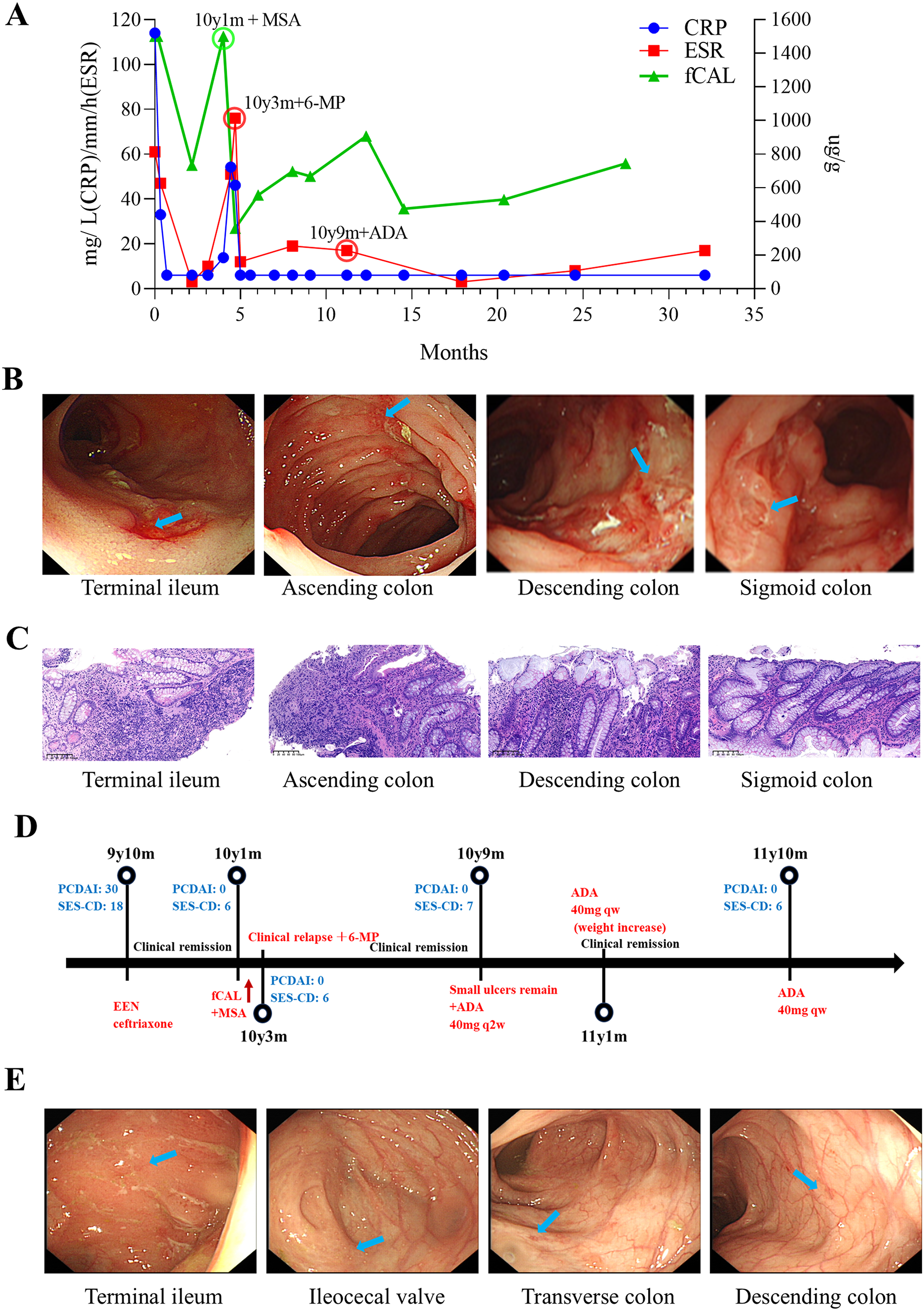 X-linked Deficiency in ELF4 in Females with Skewed X Chromosome Inactivation