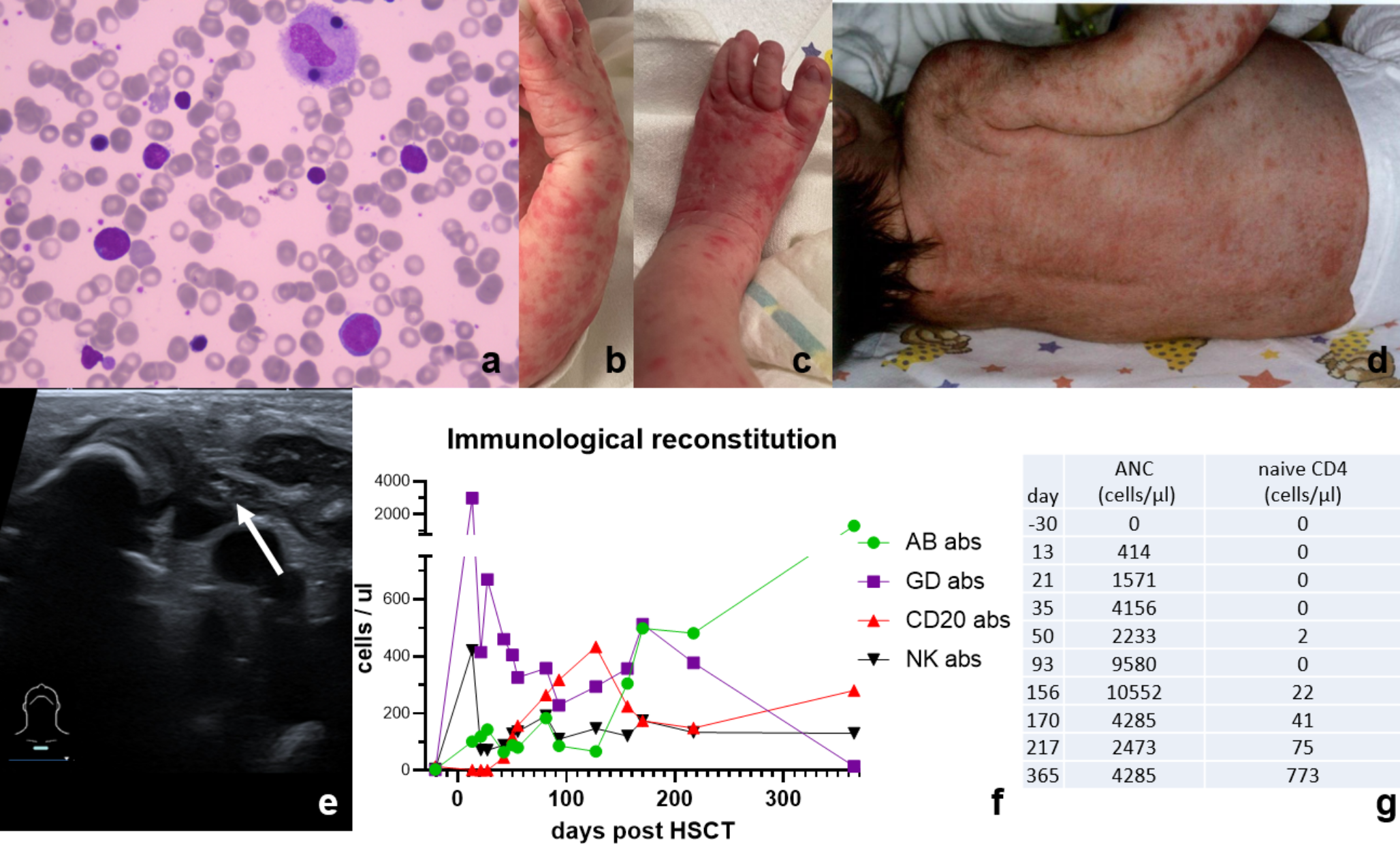 Early Haploidentical Hematopoietic Stem Cell Transplantation Provides Rapid Leukocyte and Immune Reconstitution in AK2 Patient Identified by TREC Newborn Screening