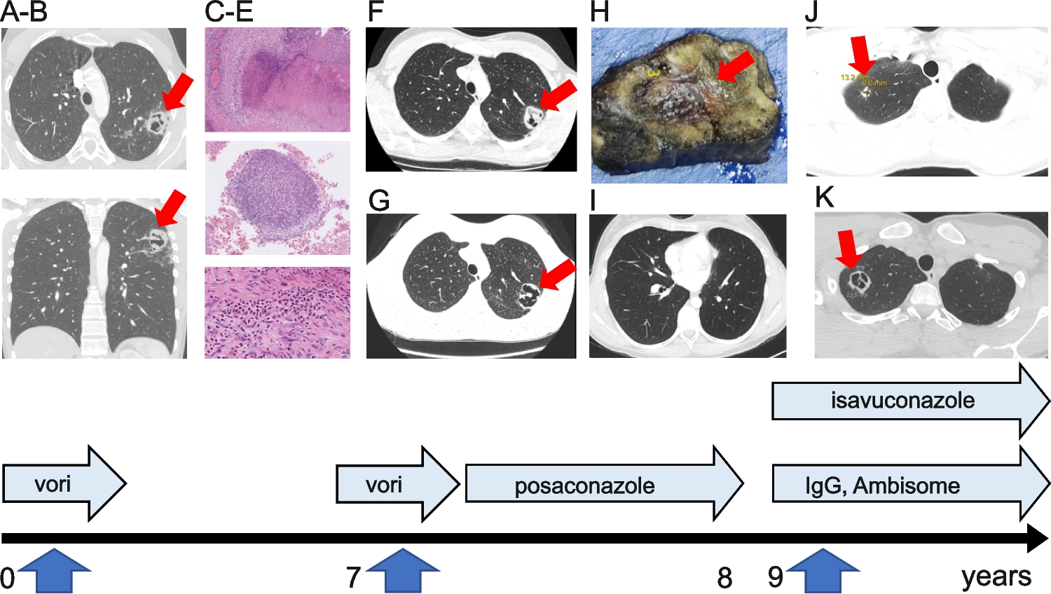 Pulmonary Aspergillosis and Low HIES Score in a Family with STAT3 N-Terminal Domain Mutation