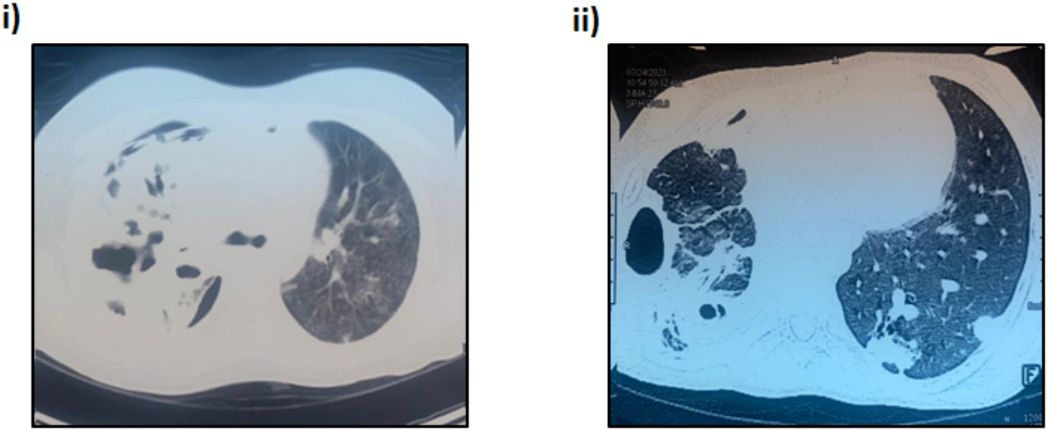Investigational antibiotic cefepime/zidebactam as a therapeutic option for the treatment of an unyielding empyema in a paediatric patient caused by extensively drug-resistant : a case report