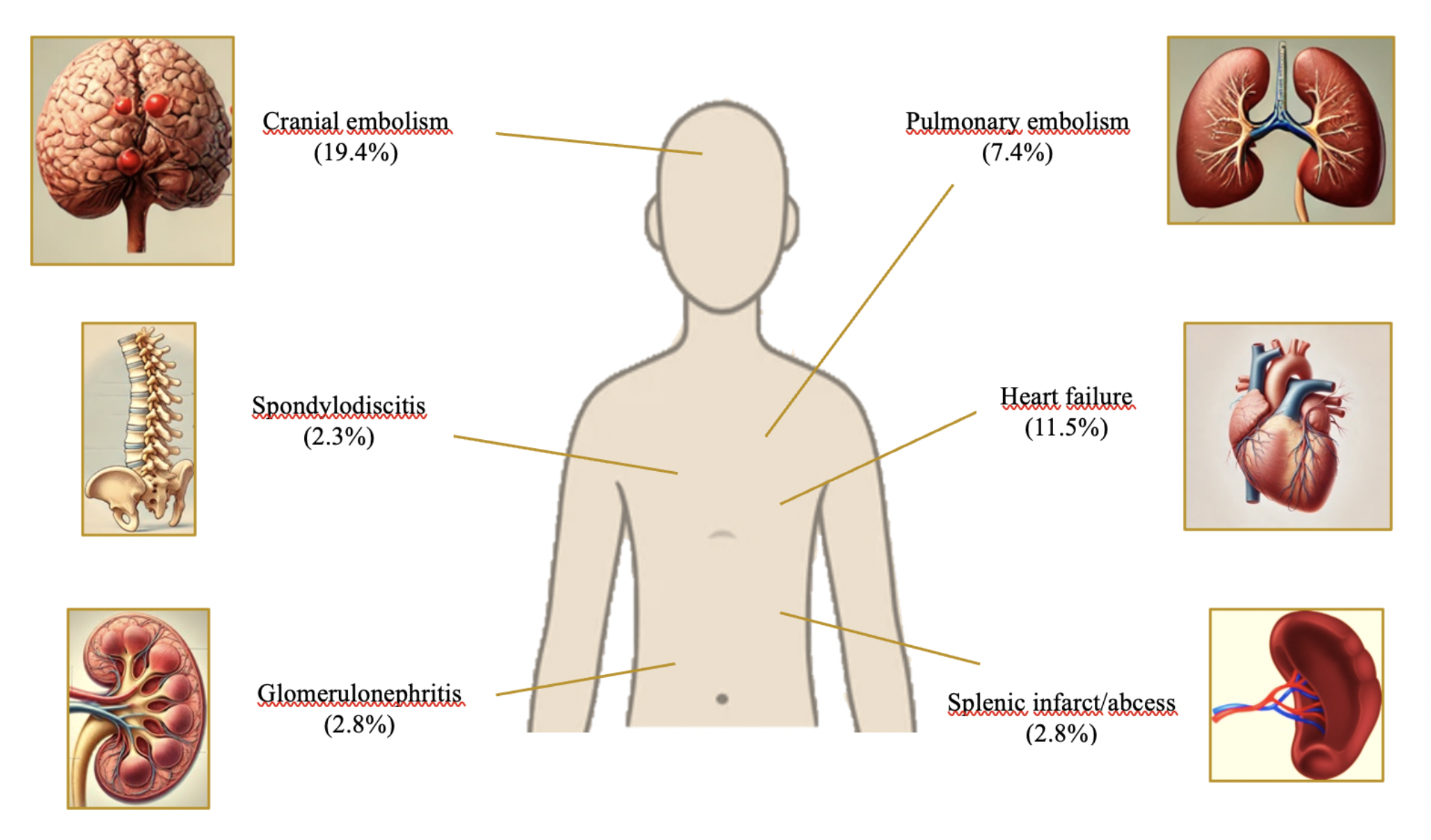 Epidemiological, clinical and microbiological aspects of infective endocarditis in Türkiye