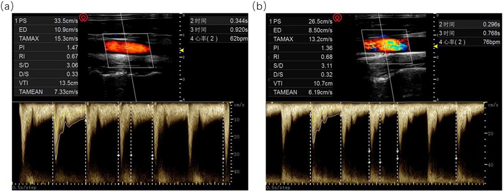 Carotid corrected flow time and Doppler shock index for prediction of post-induction hypotension in patients undergoing elective abdominal surgery: a prospective observational study