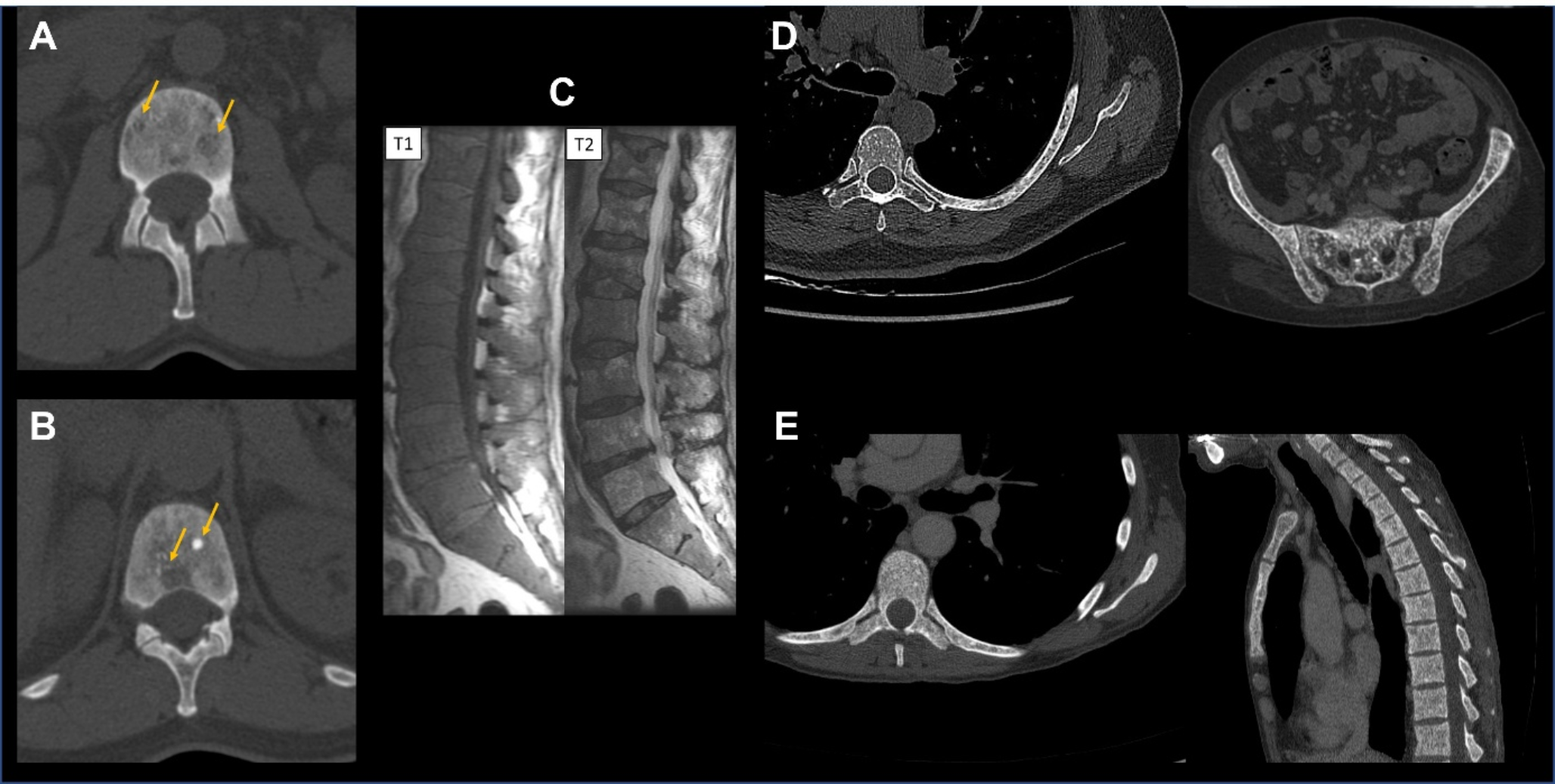 Management of Bone Health in Adult Mastocytosis