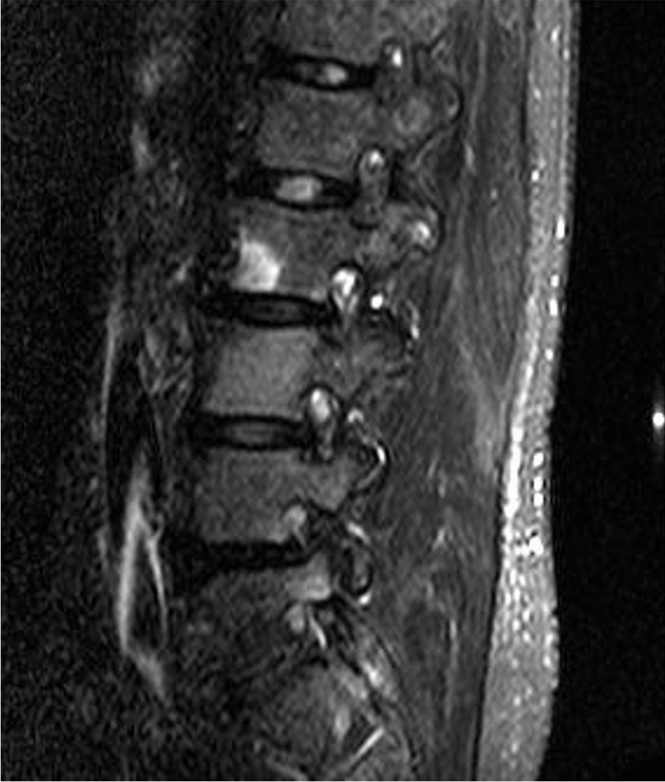 Fast, Present and Future of the Concept of Spondyloarthritis