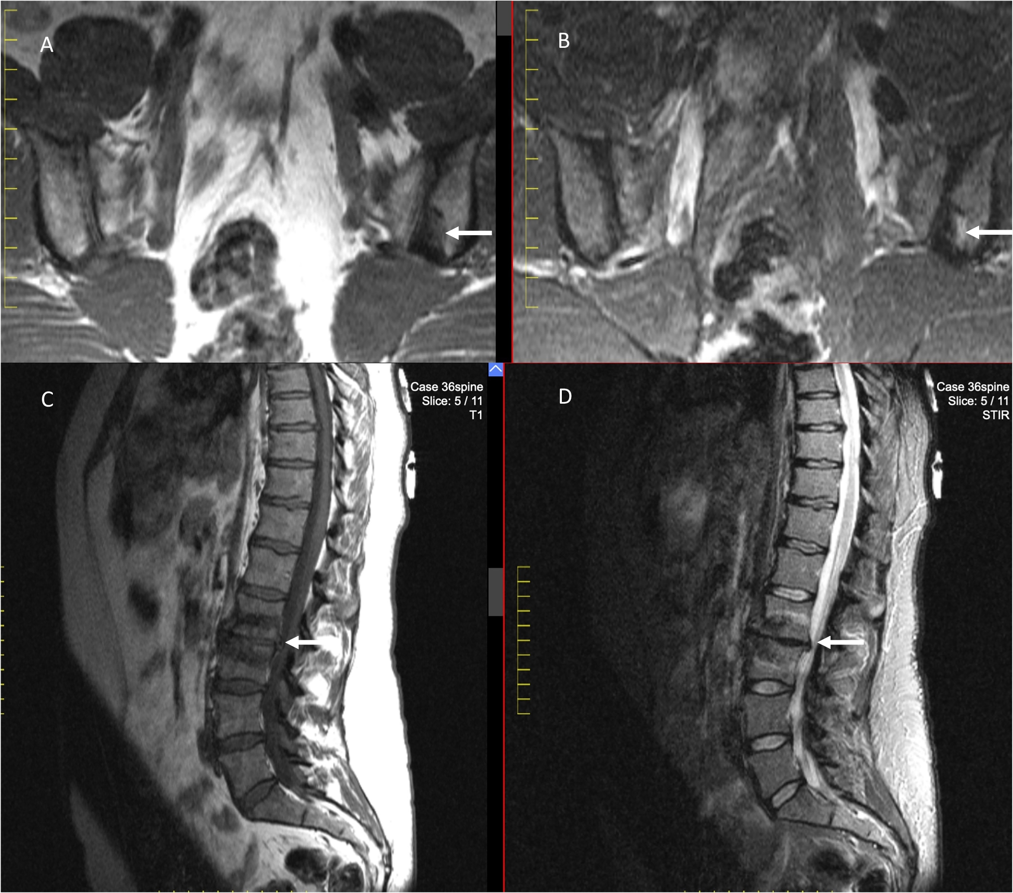 A Review on Imaging in Axial Spondyloarthritis: SPARTAN 2024 Annual Meeting Proceedings