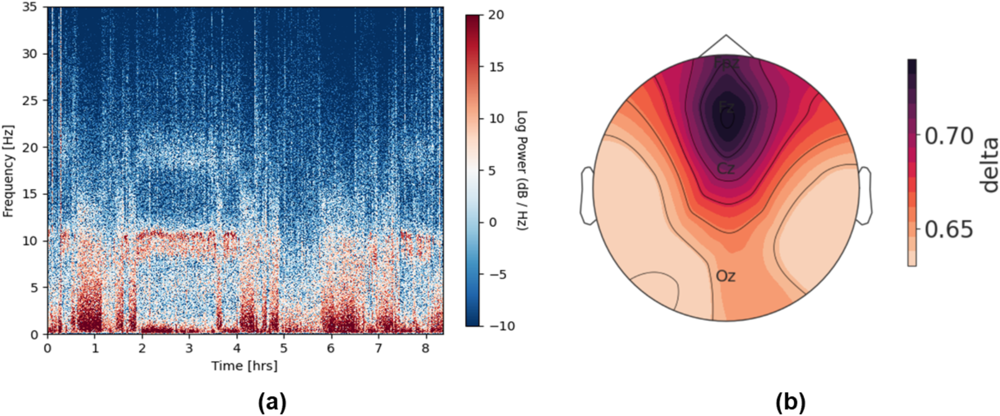 Machine learning classifier solving the problem of sleep stage imbalance between overnight sleep
