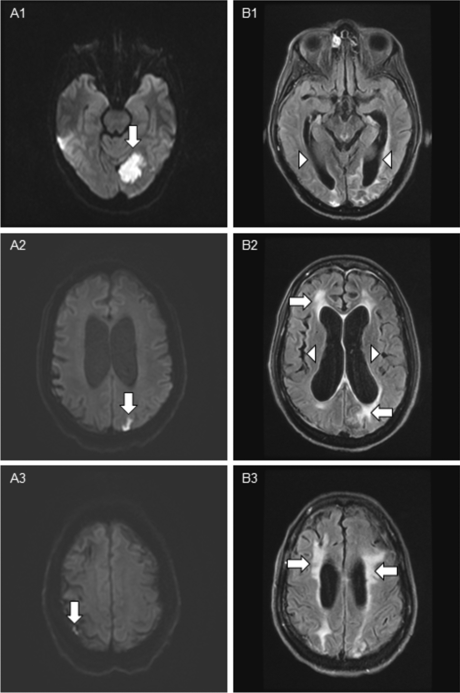 Update on Stroke Prevention and Treatment in Patients with Antiphospholipid Antibody Syndrome