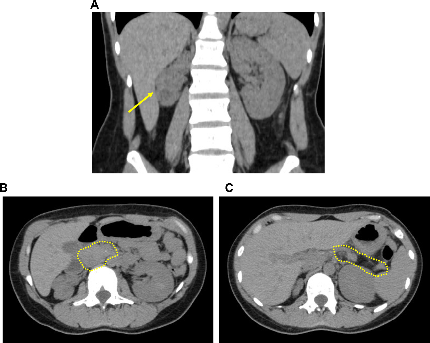 Case-based learning: a case of maturity-onset diabetes of the young 5 (MODY5) due to 17q12 microdeletion with a diminished plasma glucagon level