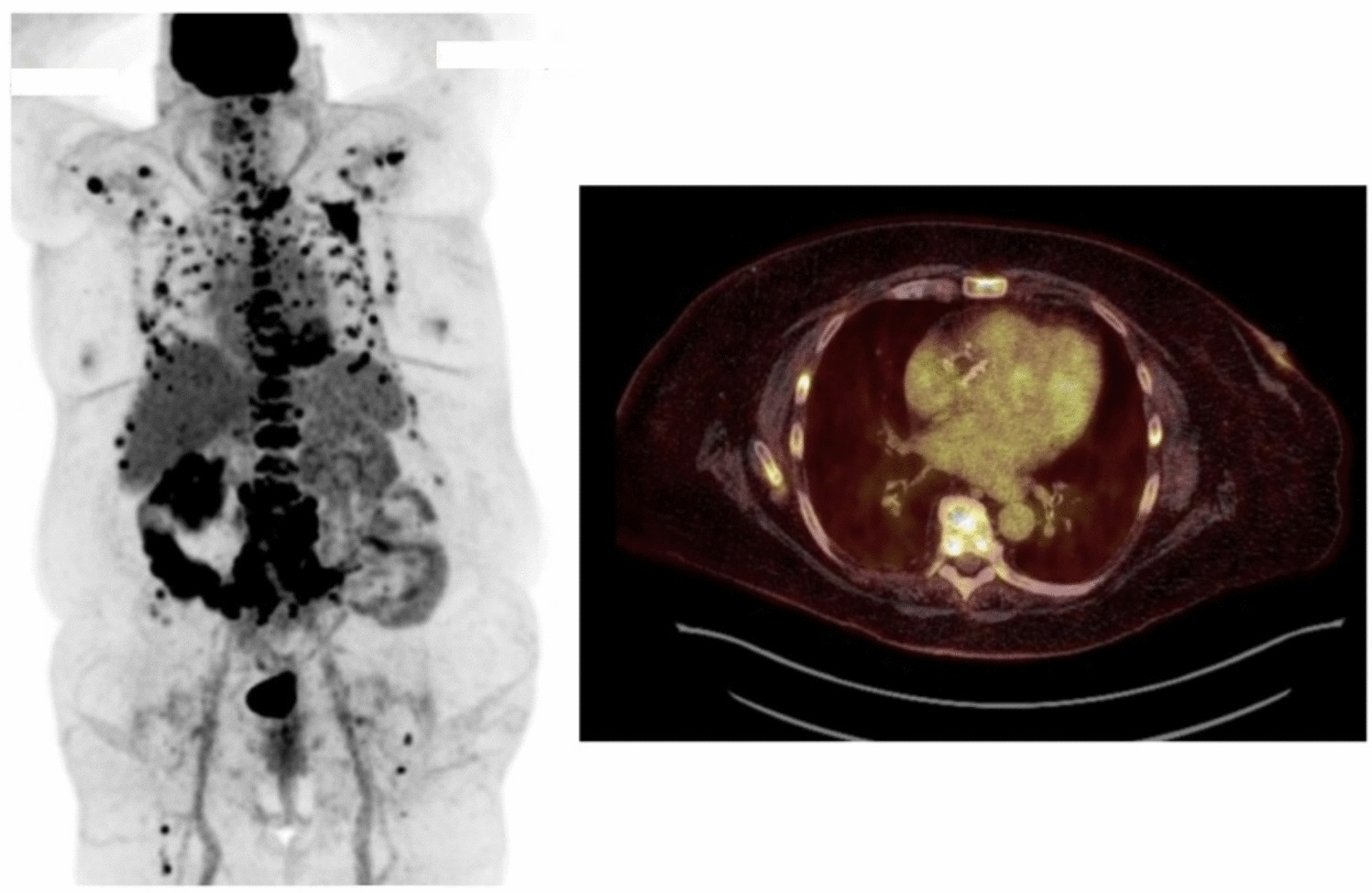 Review of Bone Metastasis in Gynecologic Malignancies: Evaluation and Treatment