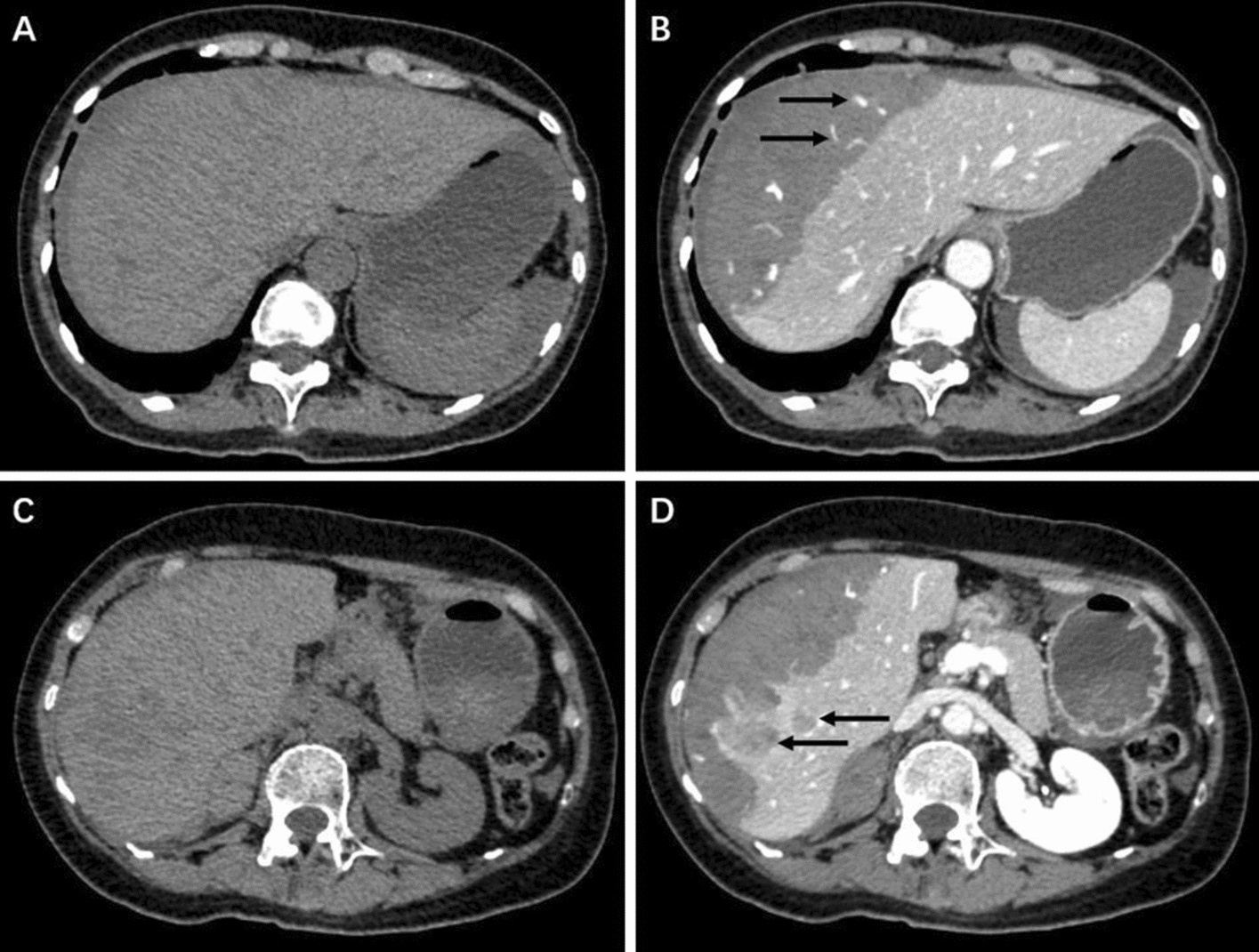 Hepatic Subcapsular Hematoma Induced by Metastatic Tumors