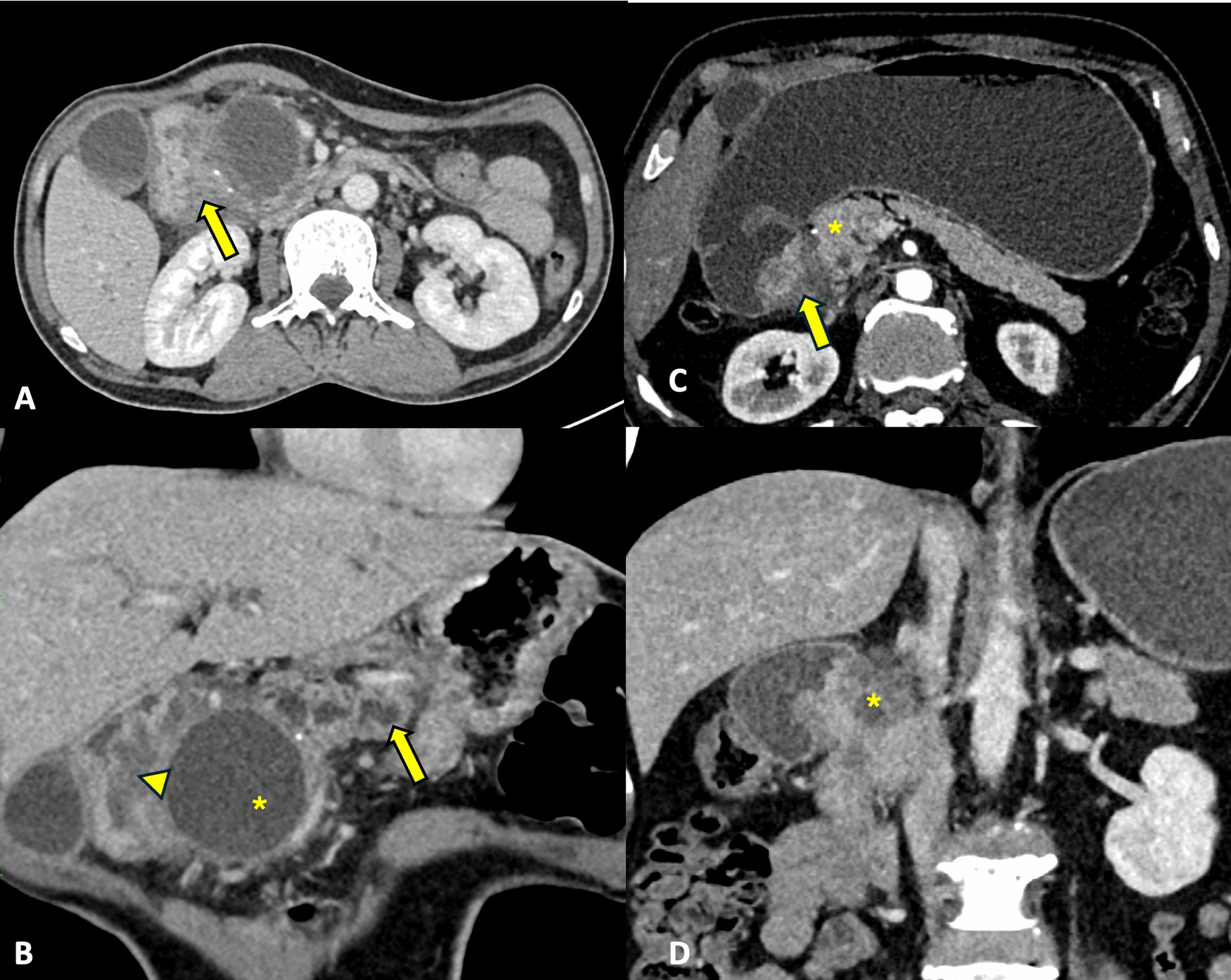 Surgical Management of Groove Pancreatitis: Lessons Learnt and Long-Term Experience