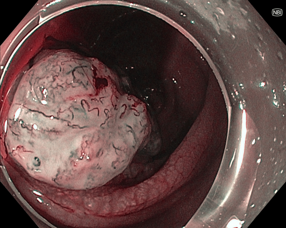 Hidden Fecalith: Uncommon Presentation Within Inflammatory Polyp