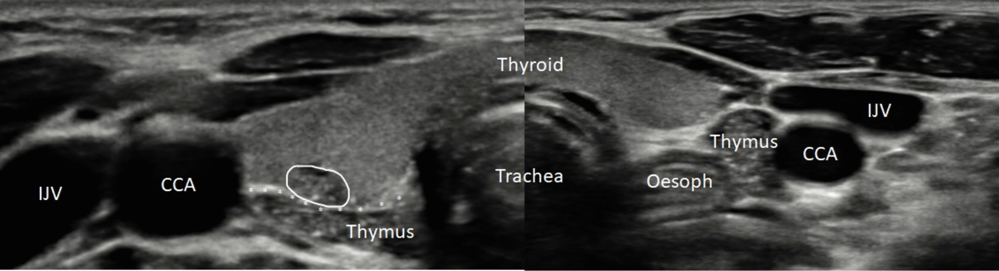 Significance of ectopic intrathyroidal thymic tissue detected on ultrasound in different paediatric age groups: a proposed classification to guide investigation and management
