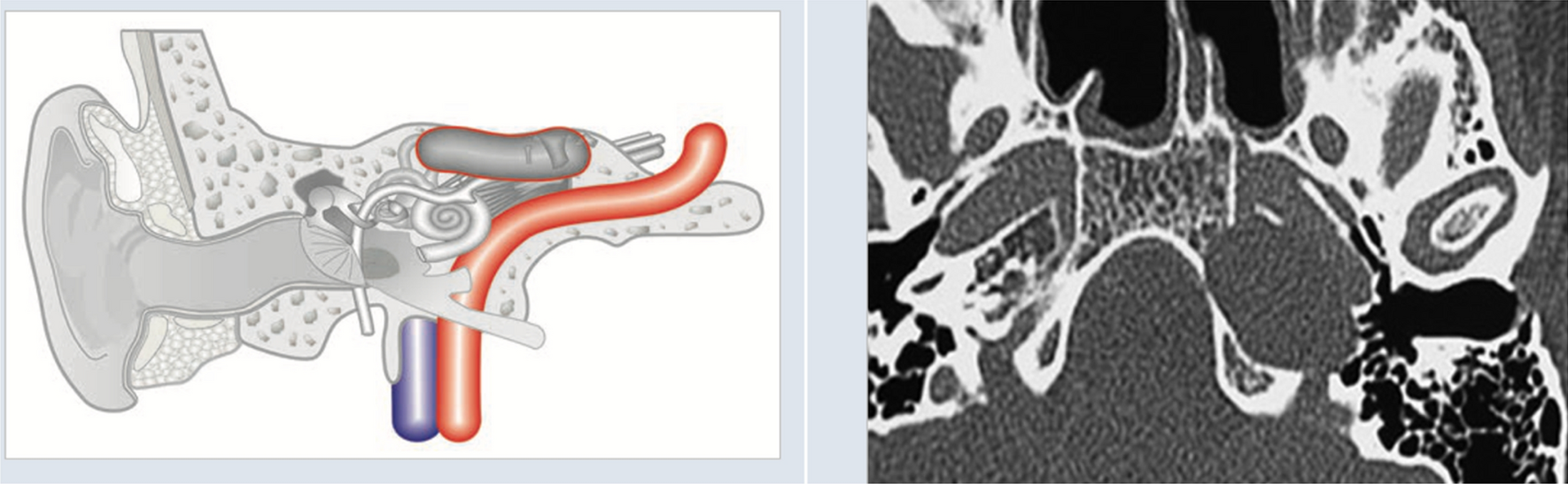 Correction: Management of Petrous Bone Cholesteatoma: The Gruppo Otologico Experience