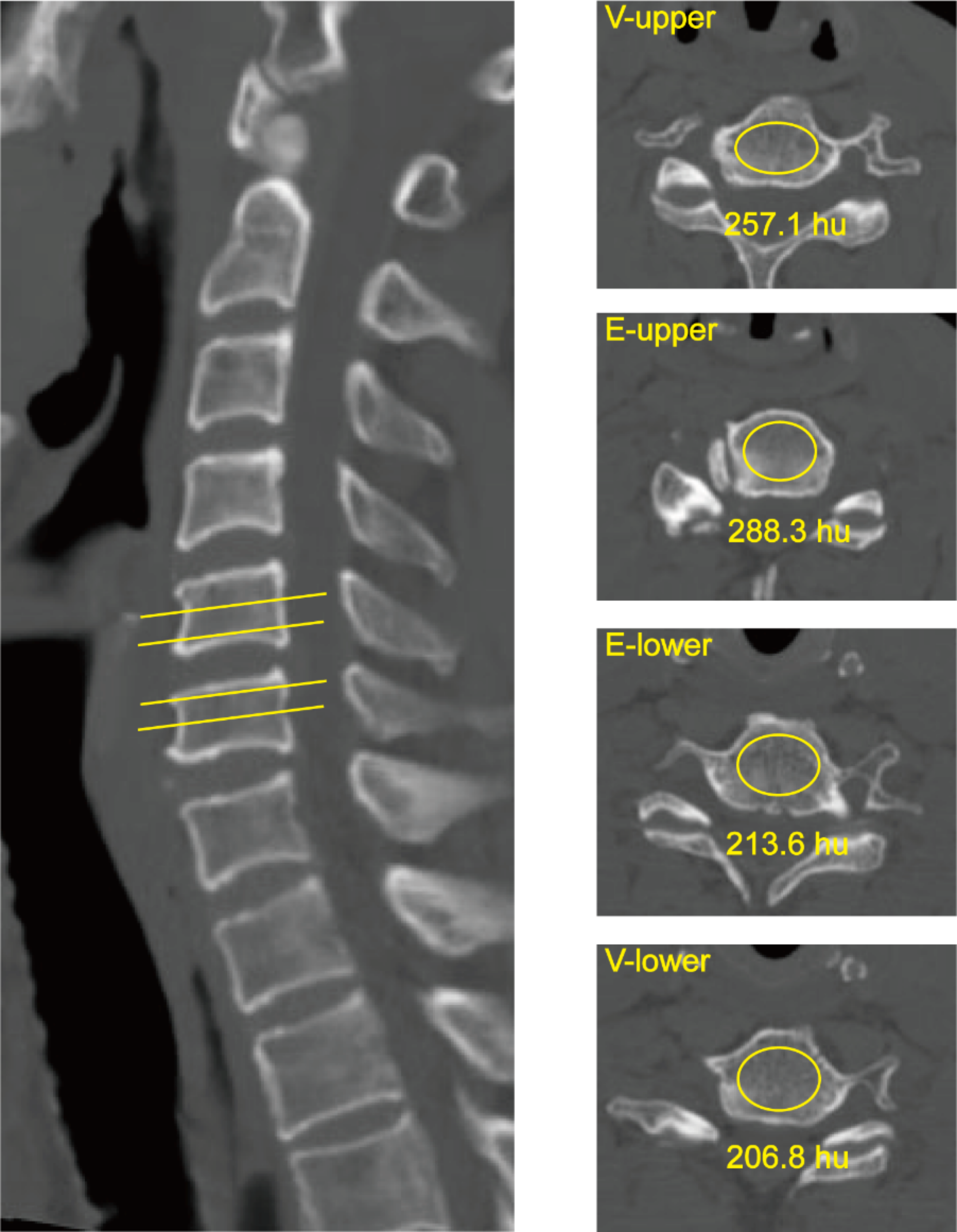 Predictive value of vertebral specificity of bone mineral density for cage subsidence among patients undergoing anterior cervical diskectomy and fusion: a retrospective study