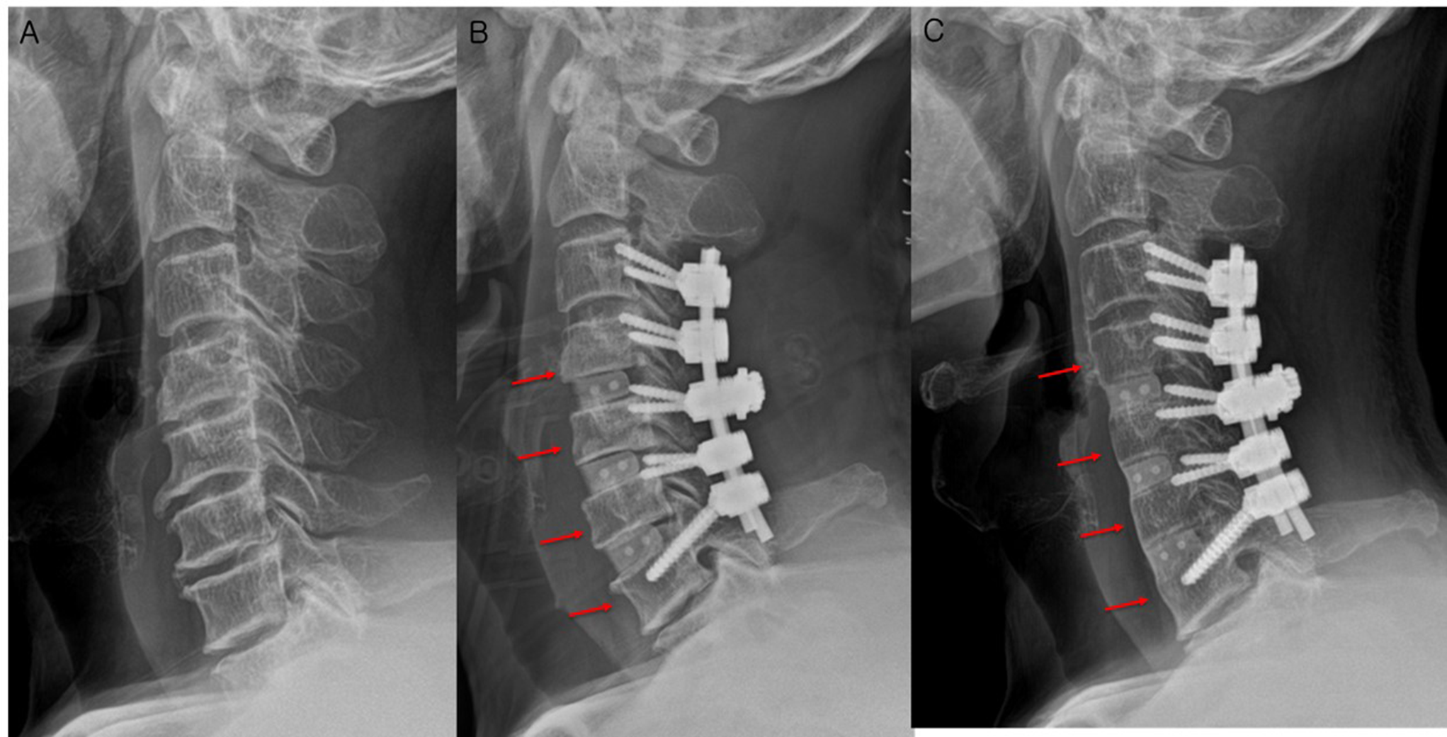Bone resorption phenomenon following anterior-posterior combined cervical fusion surgery: is it a pathologic finding?