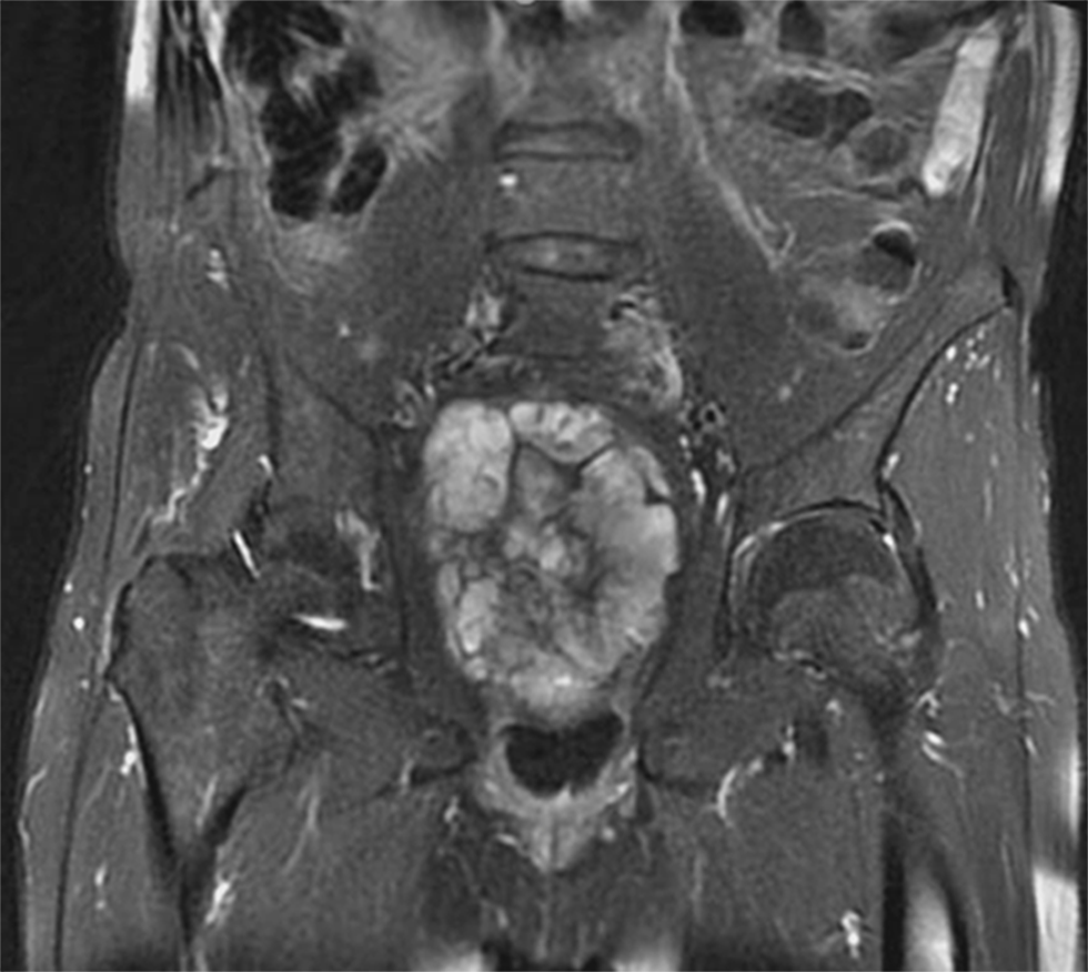 Surgical outcomes in oncological sacrectomy: a detailed analysis of surgical site infections (SSI)