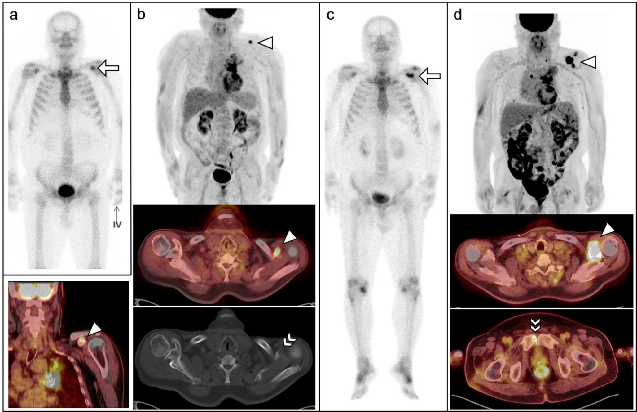 Lung Cancer with Solitary Bone Metastasis in the Coracoid Process