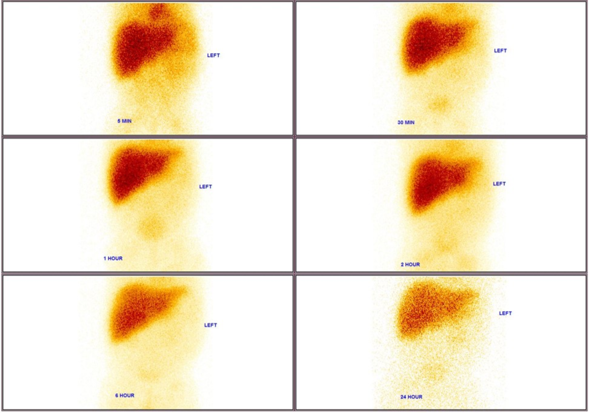 Semiquantitative parameters on hepatobiliary scintigraphy to differentiate biliary atresia from neonatal hepatitis in patients with no identifiable biliary to bowel transit