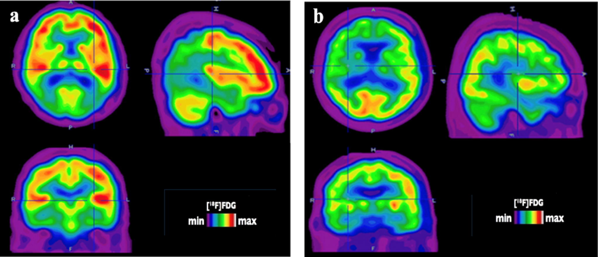 FDG-PET Image Classification in Alzheimer’s Disease: from Traditional Visual Analysis to Advanced Transfer Learning